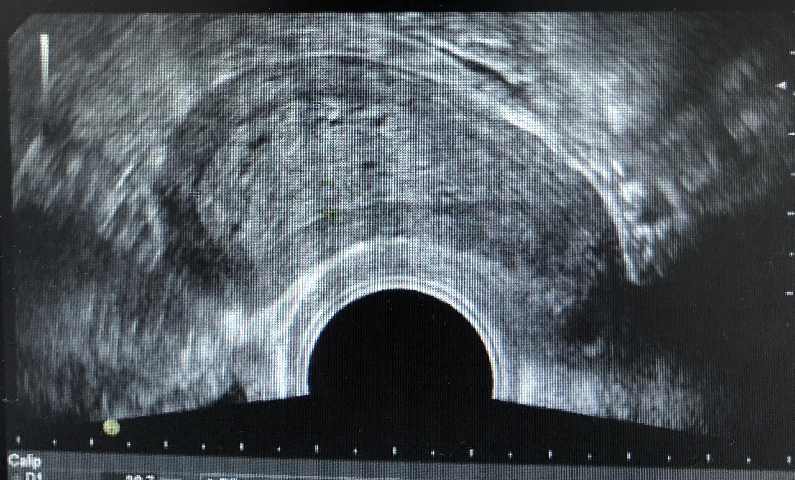 子宫内膜息肉在阴道超声影像下的误诊分析