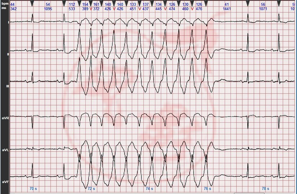 心电图图例分析:窦性心动过缓,短阵室性心动过
