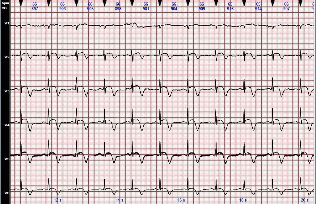 心电图表现为st段抬高的急性心肌炎