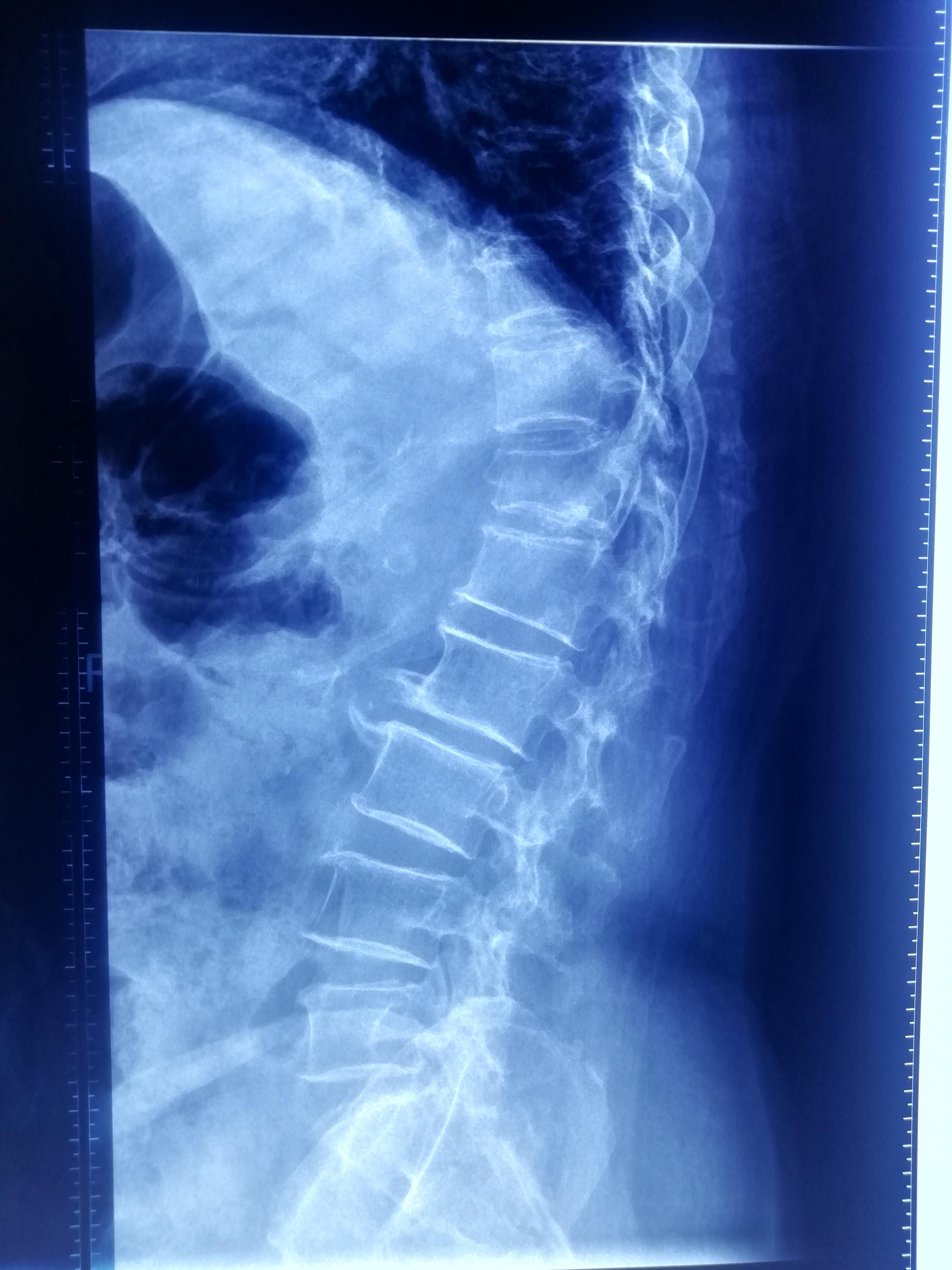 胸十二椎骨折后遗症图片