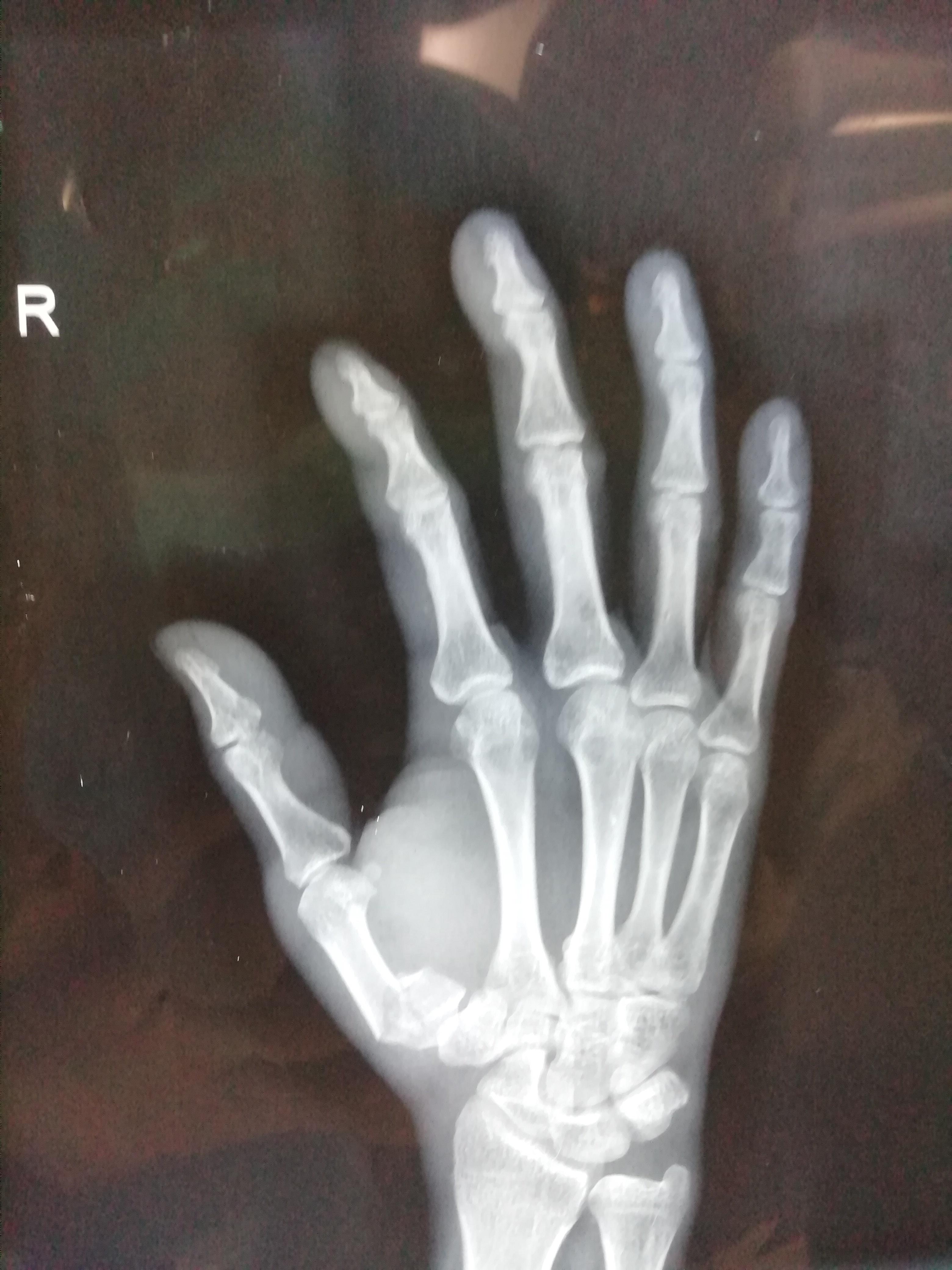 病例22 桡骨远端伸直型骨折-特种医学-医学