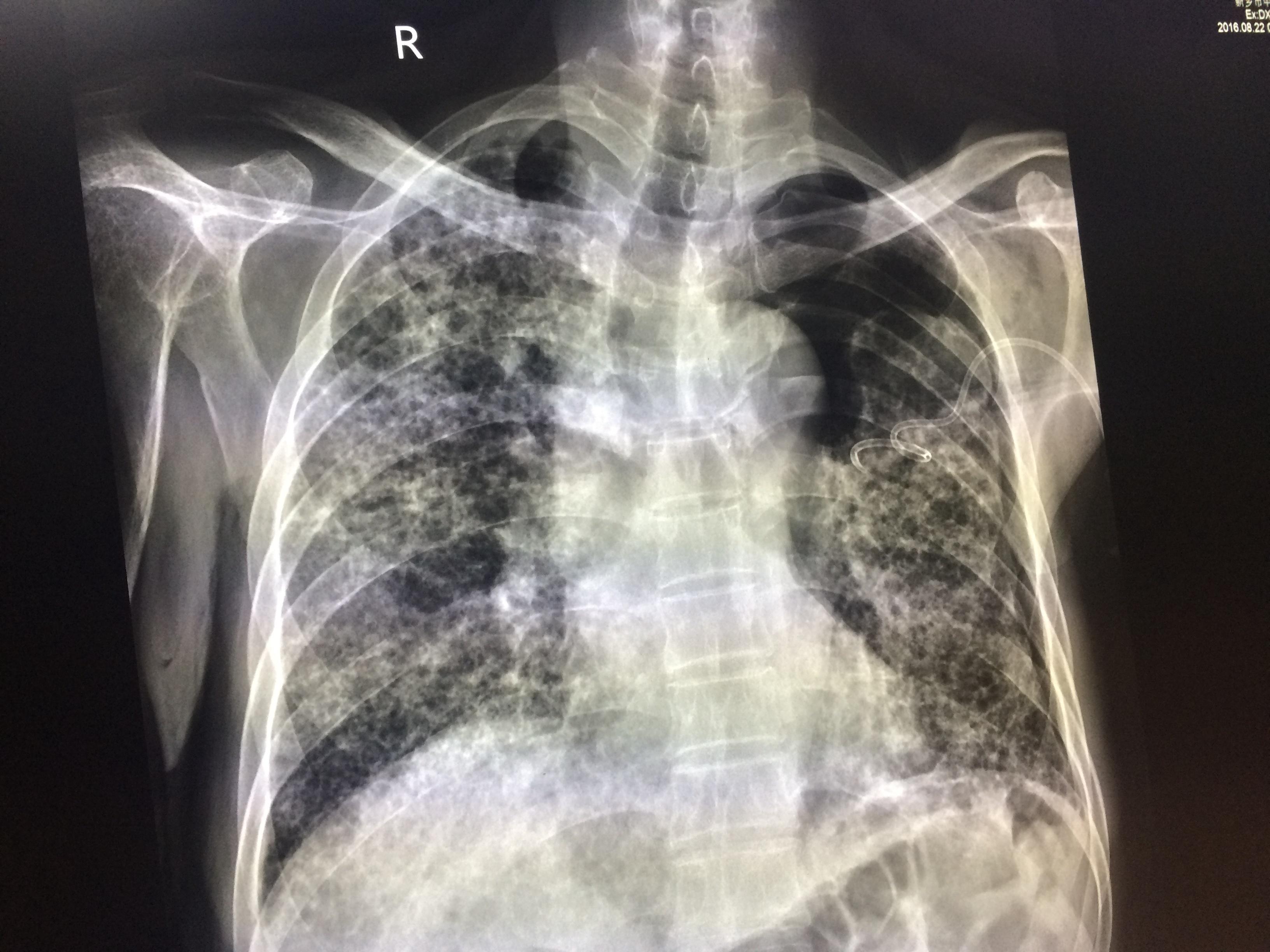 肺间质纤维化合并气胸 - 病例中心(诊疗助手) - 爱爱医医学网