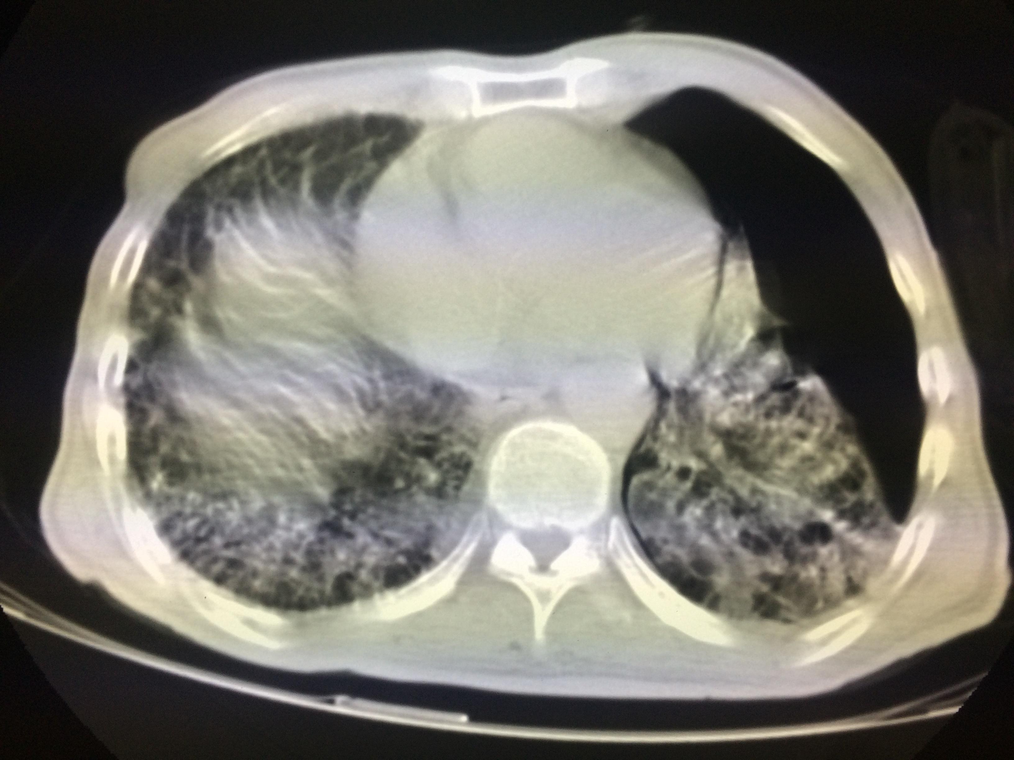 肺纤维化图片_肺纤维化症状表现图片大全_有来医生