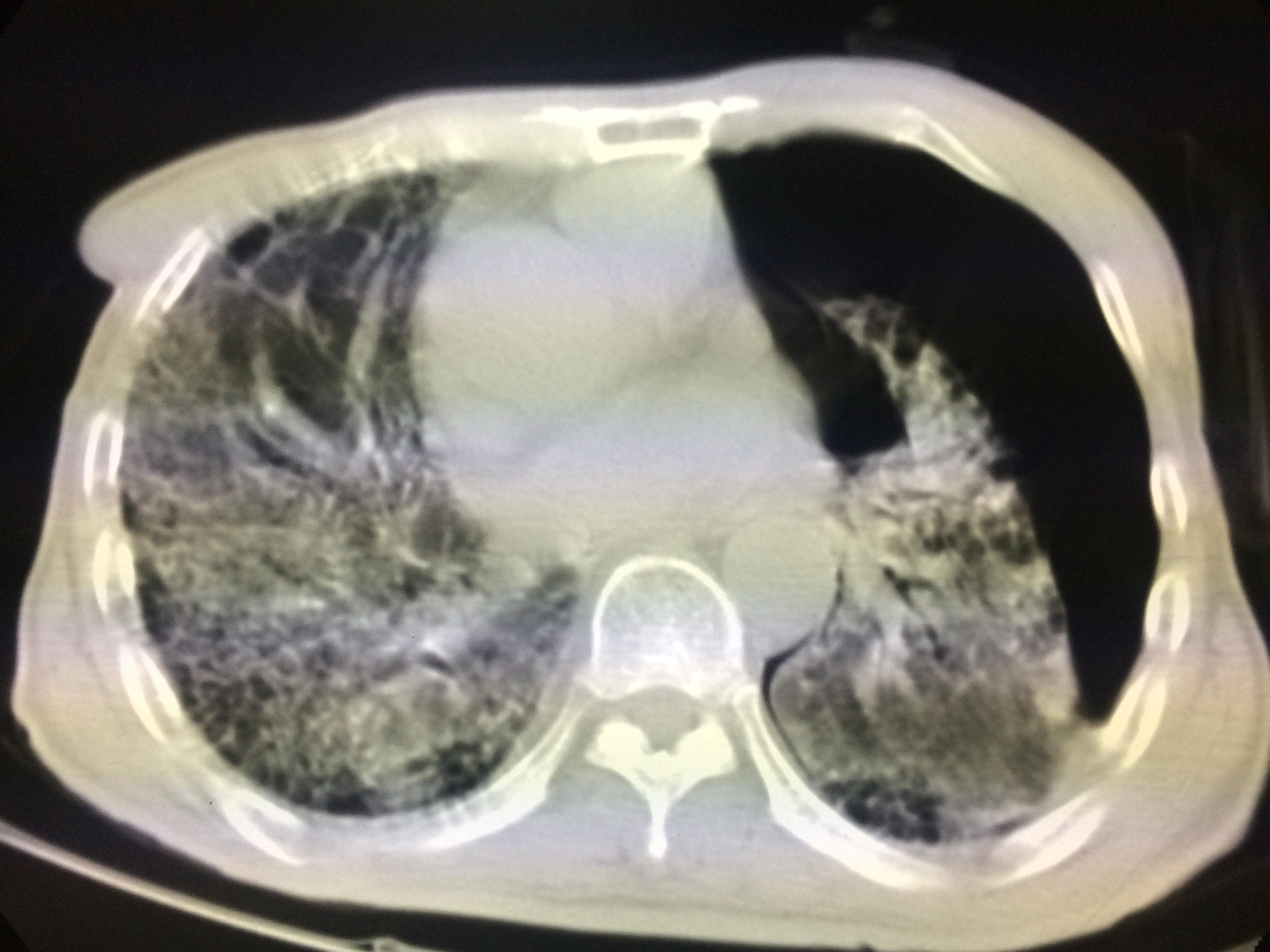 肺纤维化图片_肺纤维化症状表现图片大全_有来医生