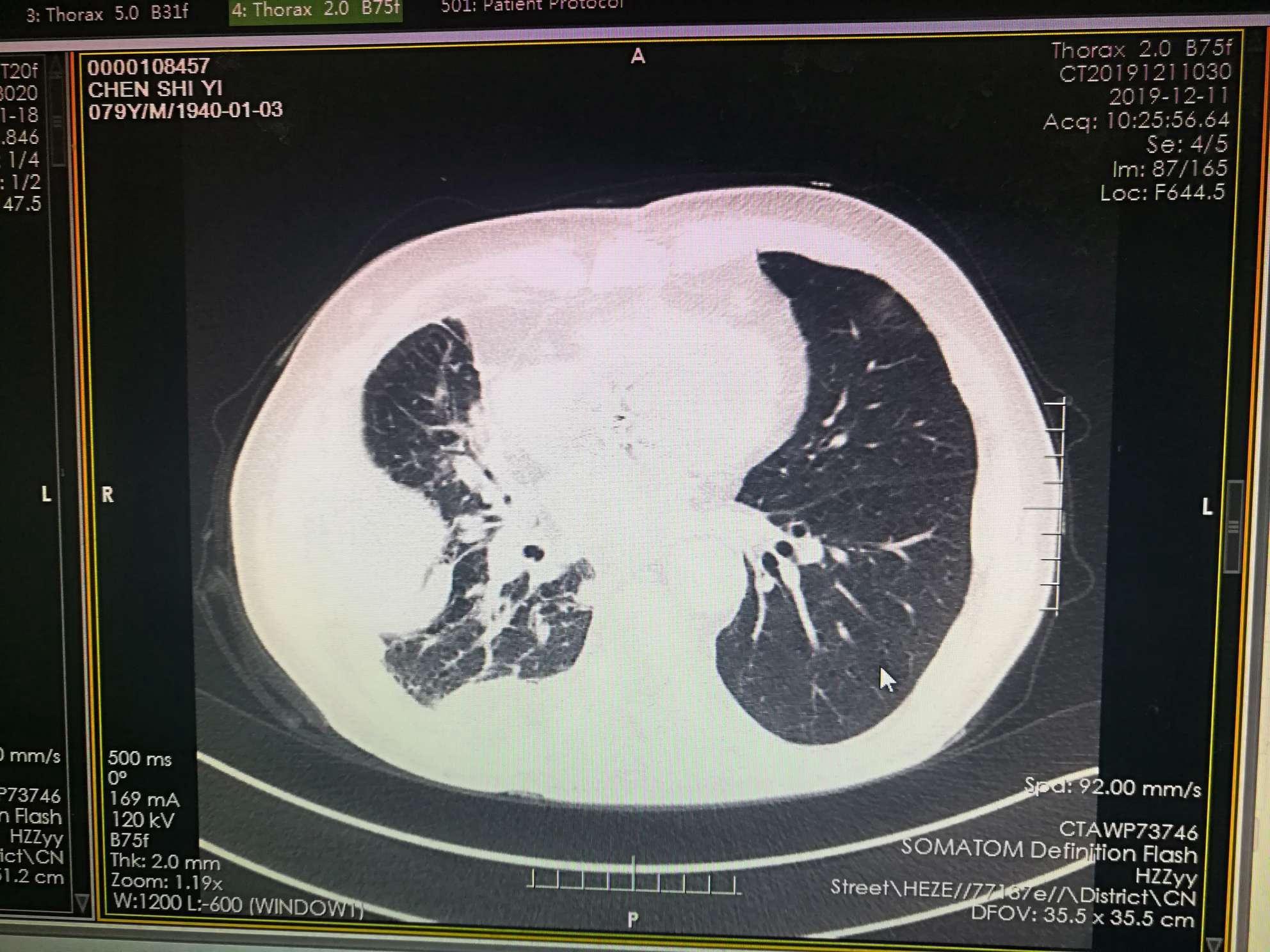 射频消融治疗晚期肺癌典型病例—小李飞针（3） - 微医（挂号网）