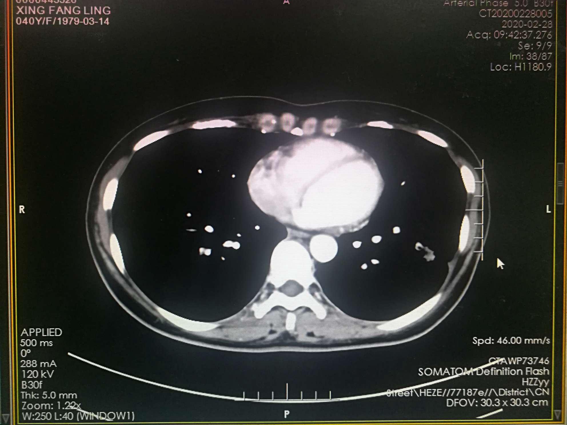 右肺周围型肺癌并双肺、右侧胸膜转移1例 - 病例中心(诊疗助手) - 爱爱医医学网