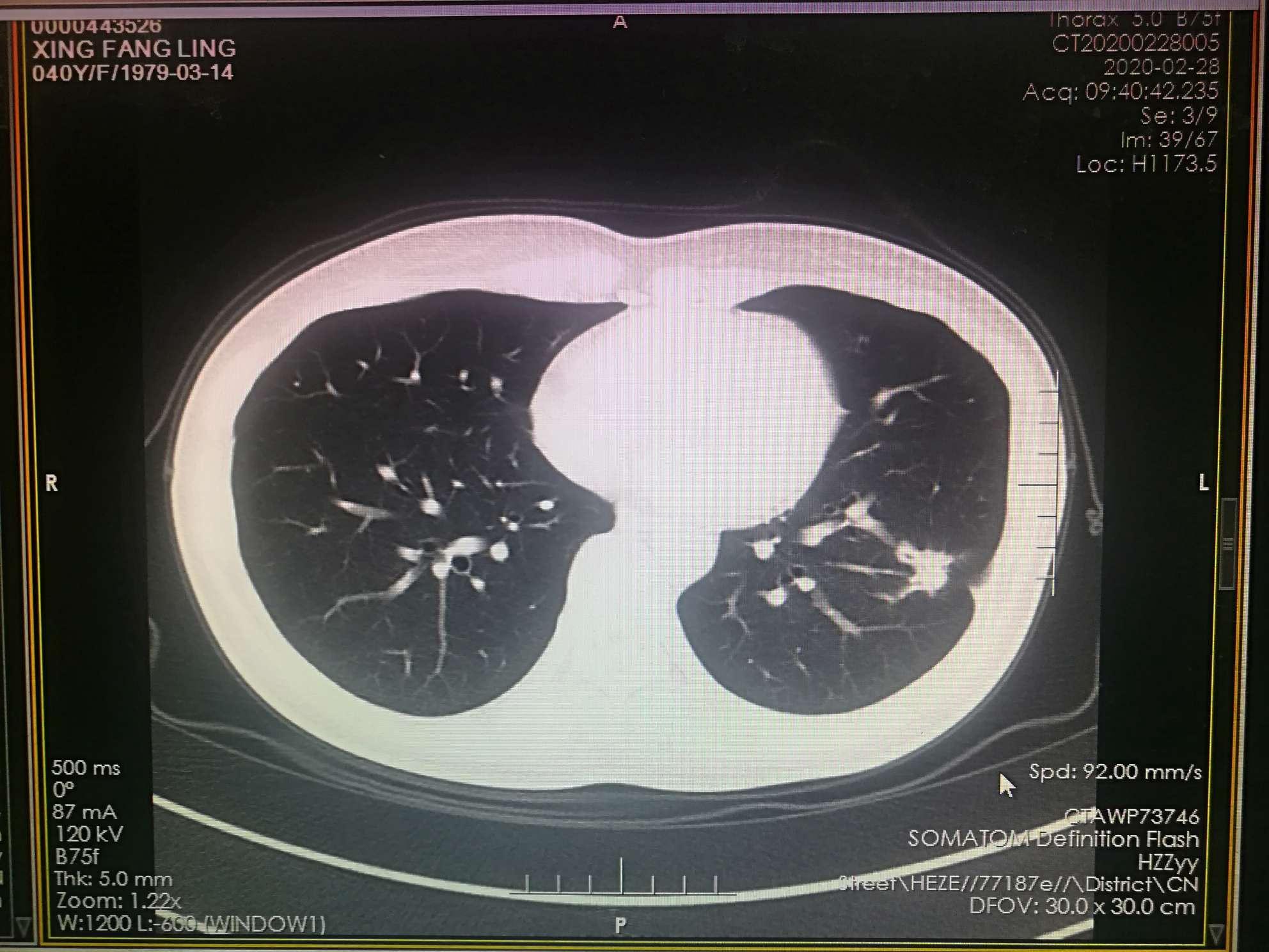 早期肺腺癌CT表现之早期浸润性肺腺癌-健康界