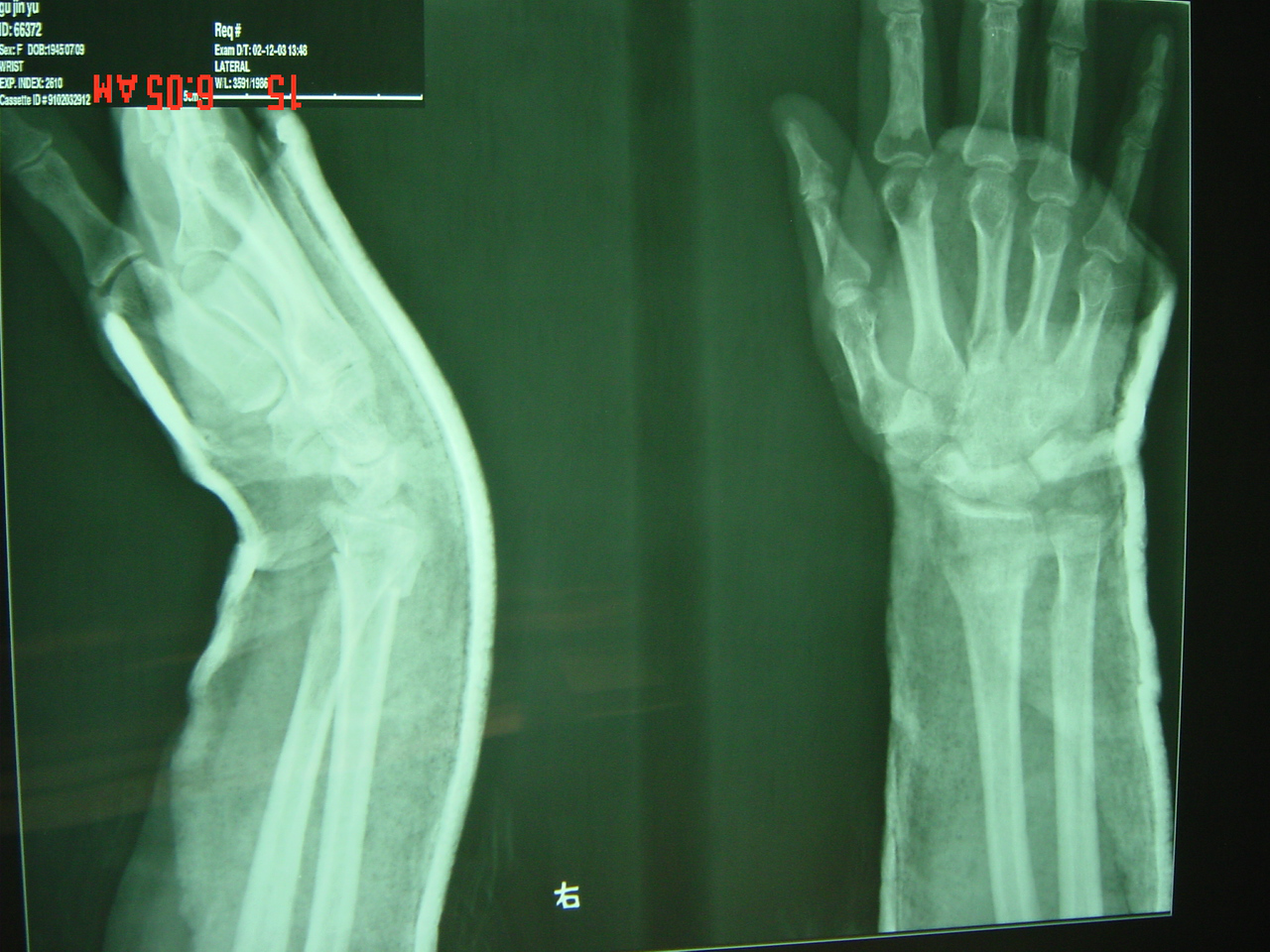 病例22 桡骨远端伸直型骨折-特种医学-医学