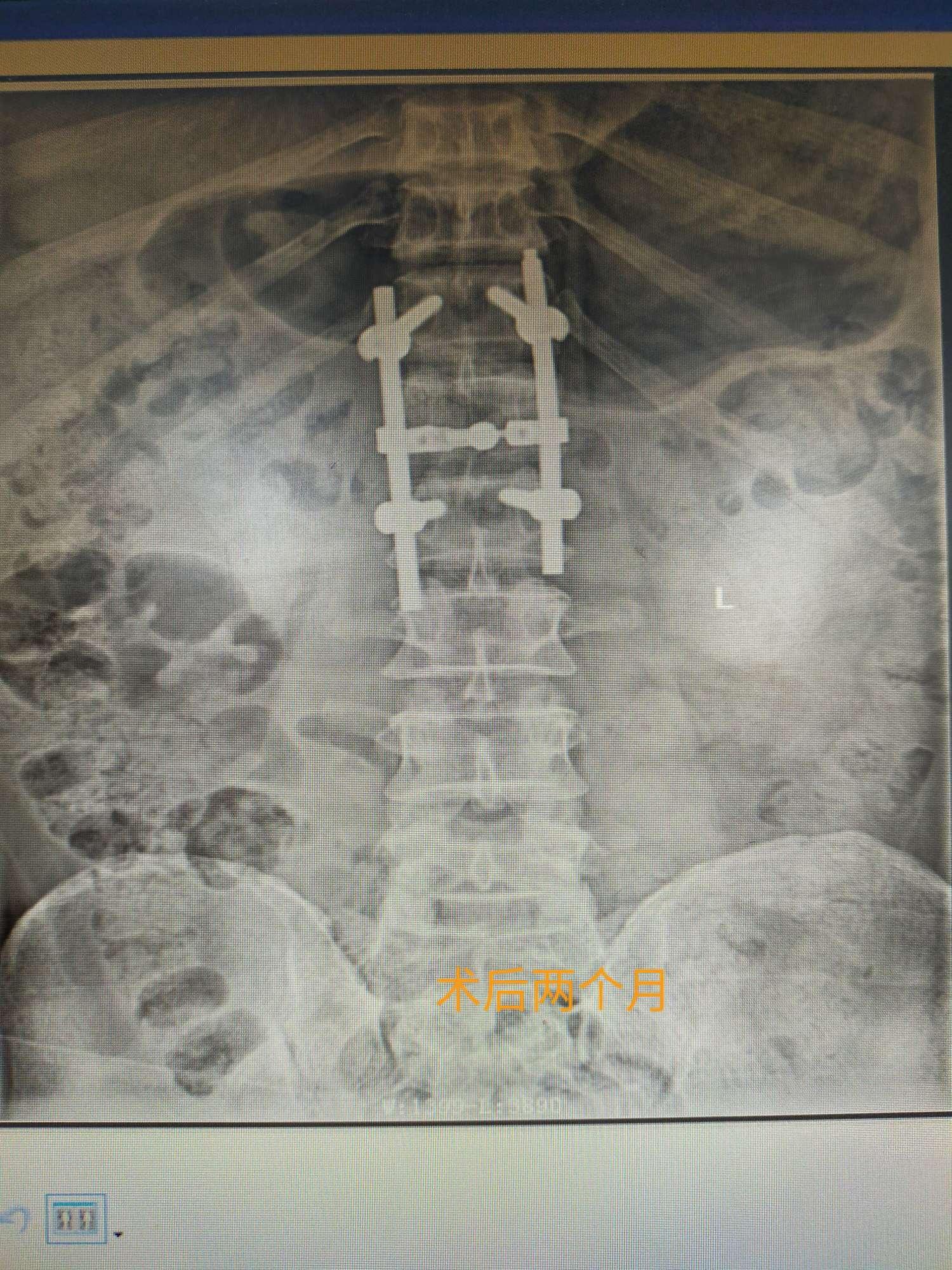 胸椎和腰椎椎体骨折常规手术治疗-基础医学-医学