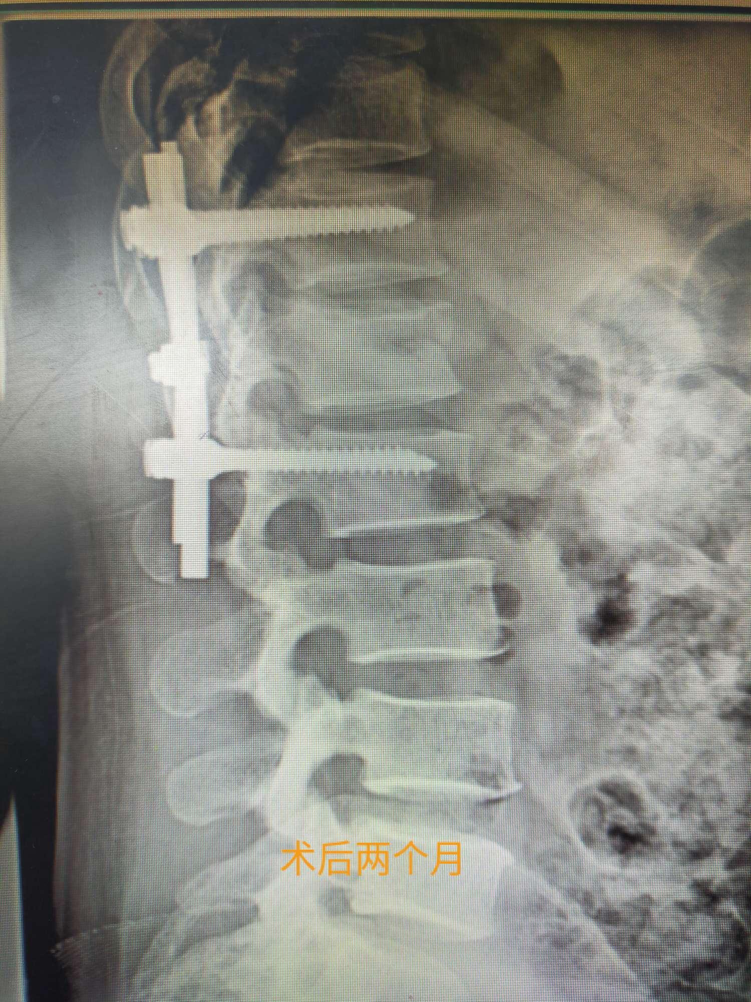 腰椎间盘突出并椎管狭窄手术病例分享