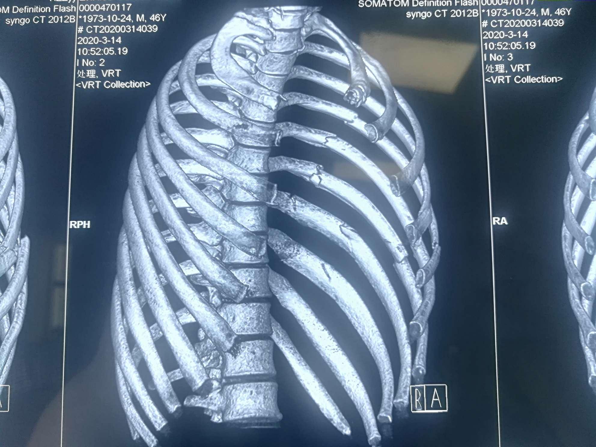 病例24 肋骨骨折-临床影像诊断-医学