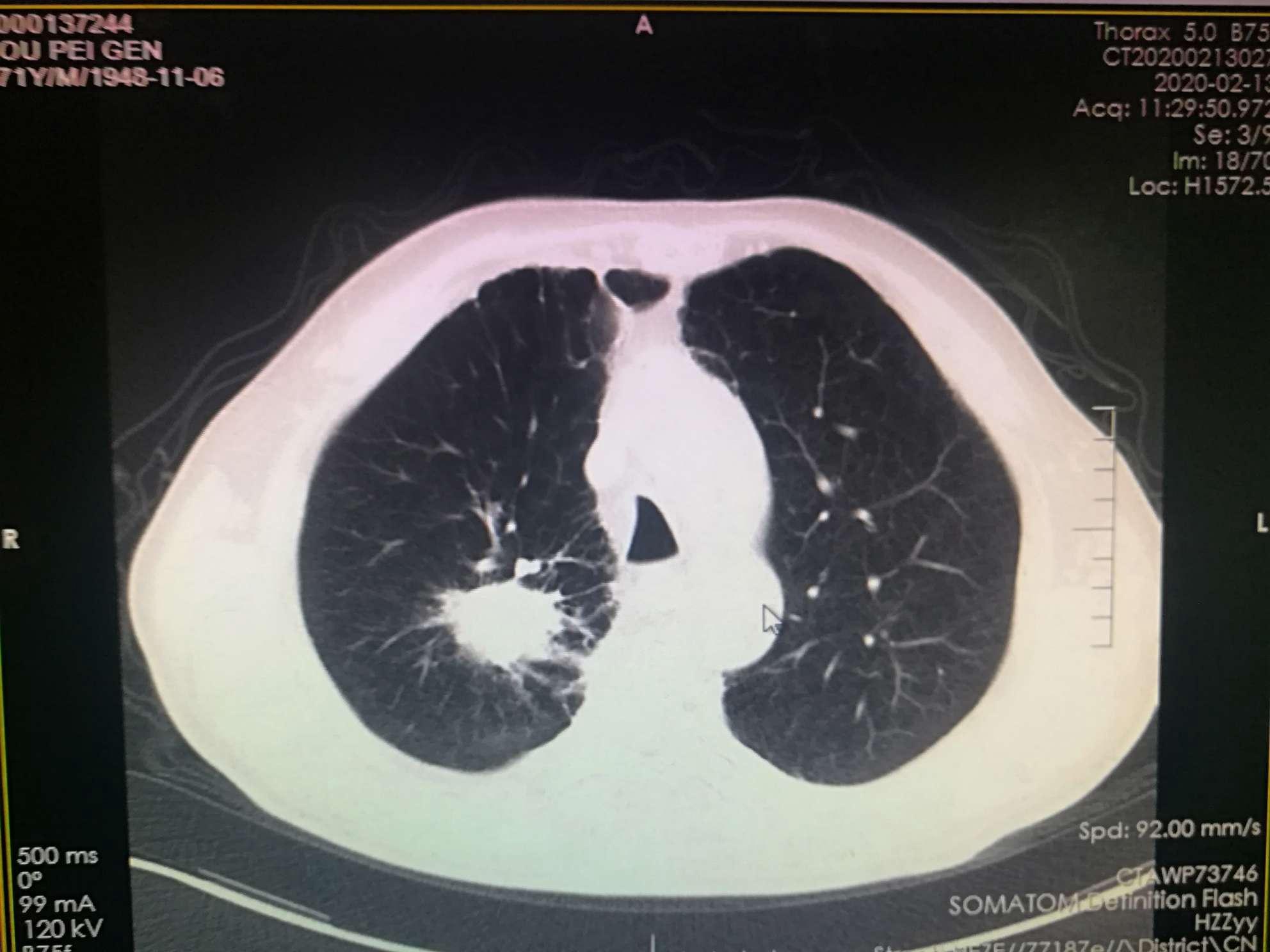 肺鳞癌ct图片