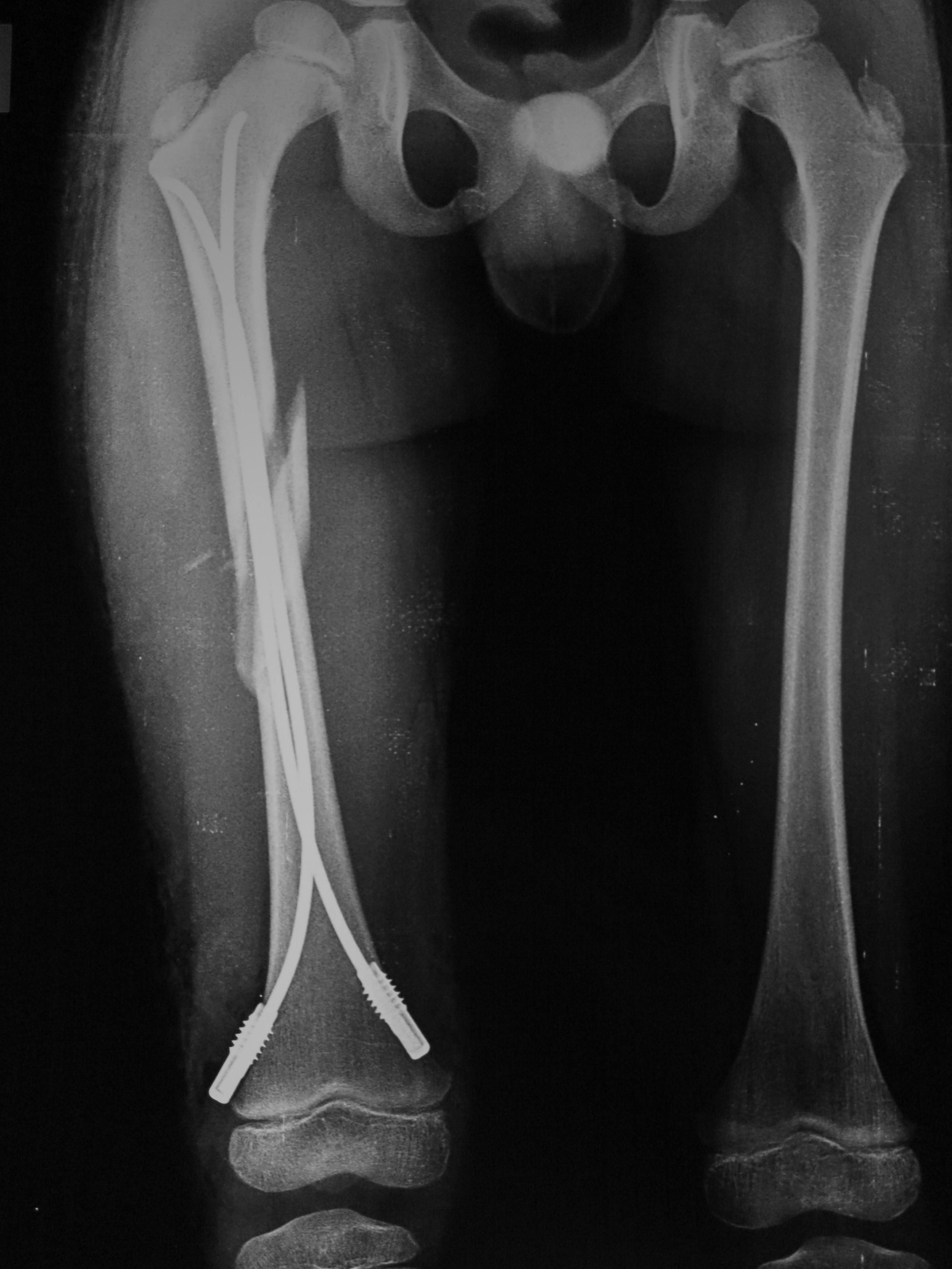 一例股骨干中下段螺旋骨折的倒打髓内钉治疗