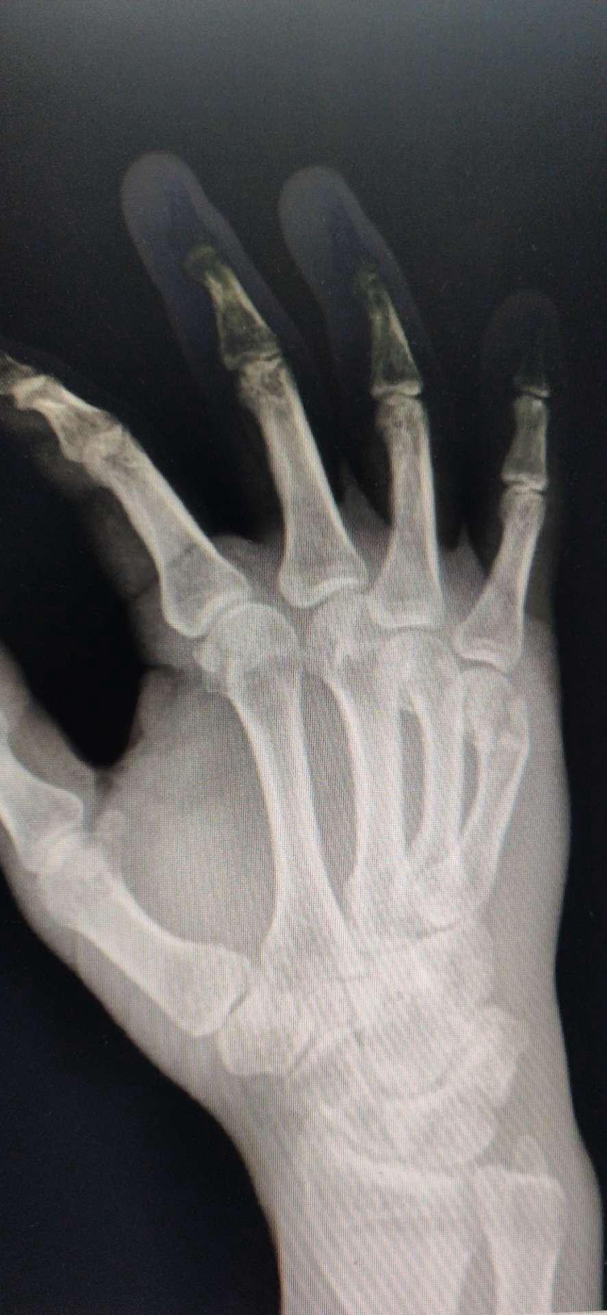 一例右手第5掌骨粉碎性骨折切开复位术及异体骨植骨术治疗分享 病例中心 诊疗助手 爱爱医医学网
