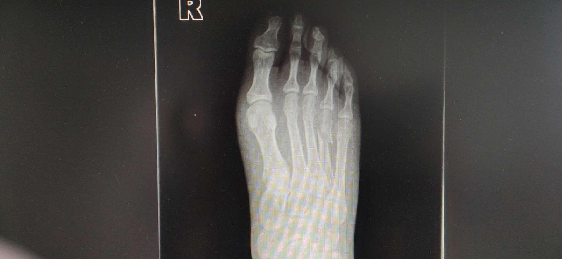 小脚趾骨折,医用小脚趾骨折固定器 - 伤感说说吧