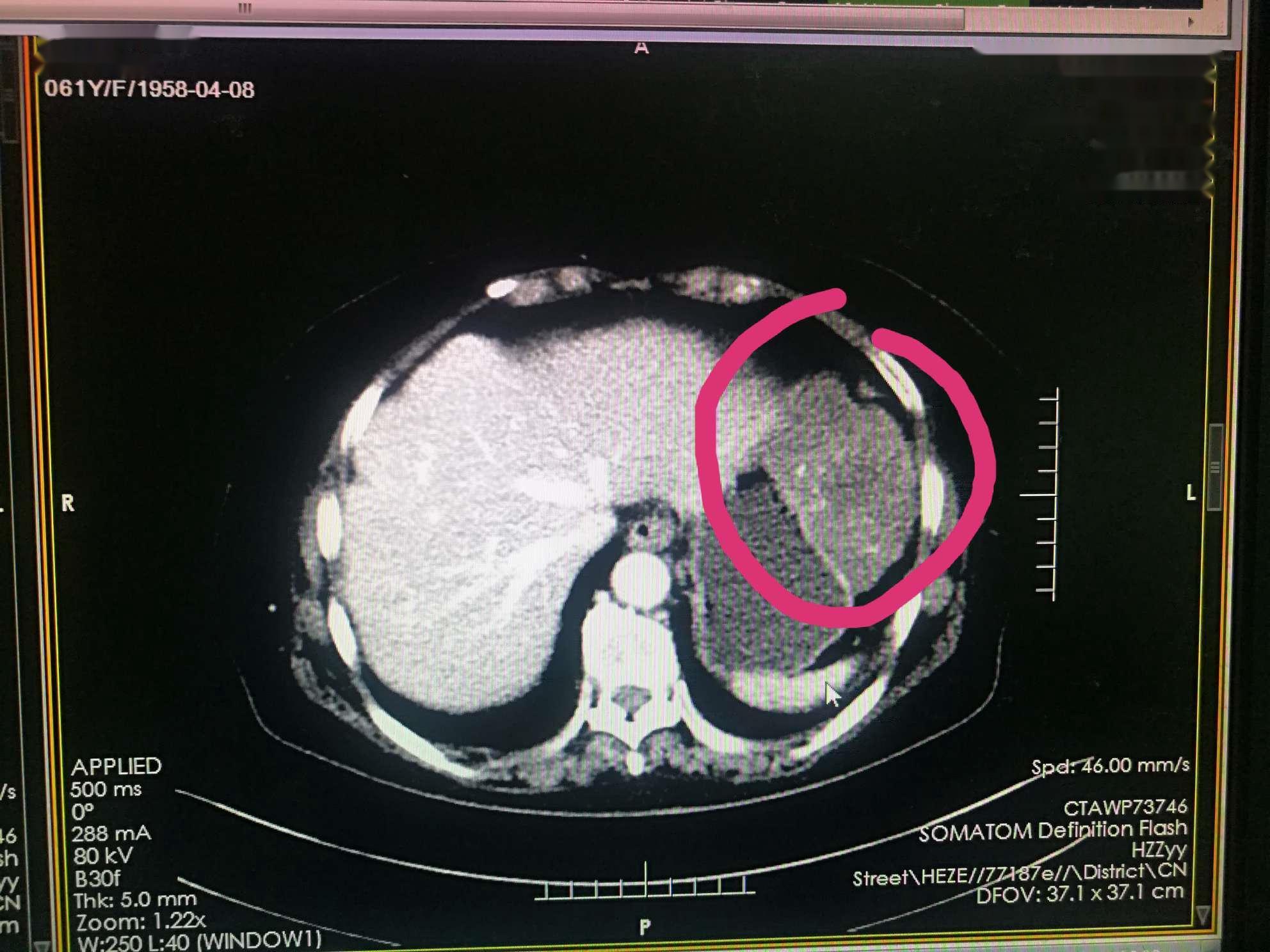 病例-83 肺非霍奇金淋巴瘤(弥漫性大B 细胞淋巴瘤)-少见病影像-医学