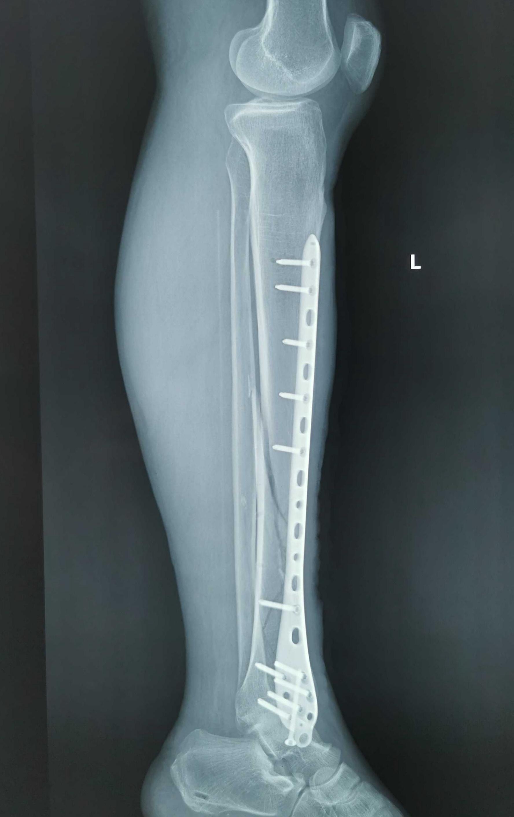 大腿骨転子部骨折の評価から治療 | 理学療法要点ドン！