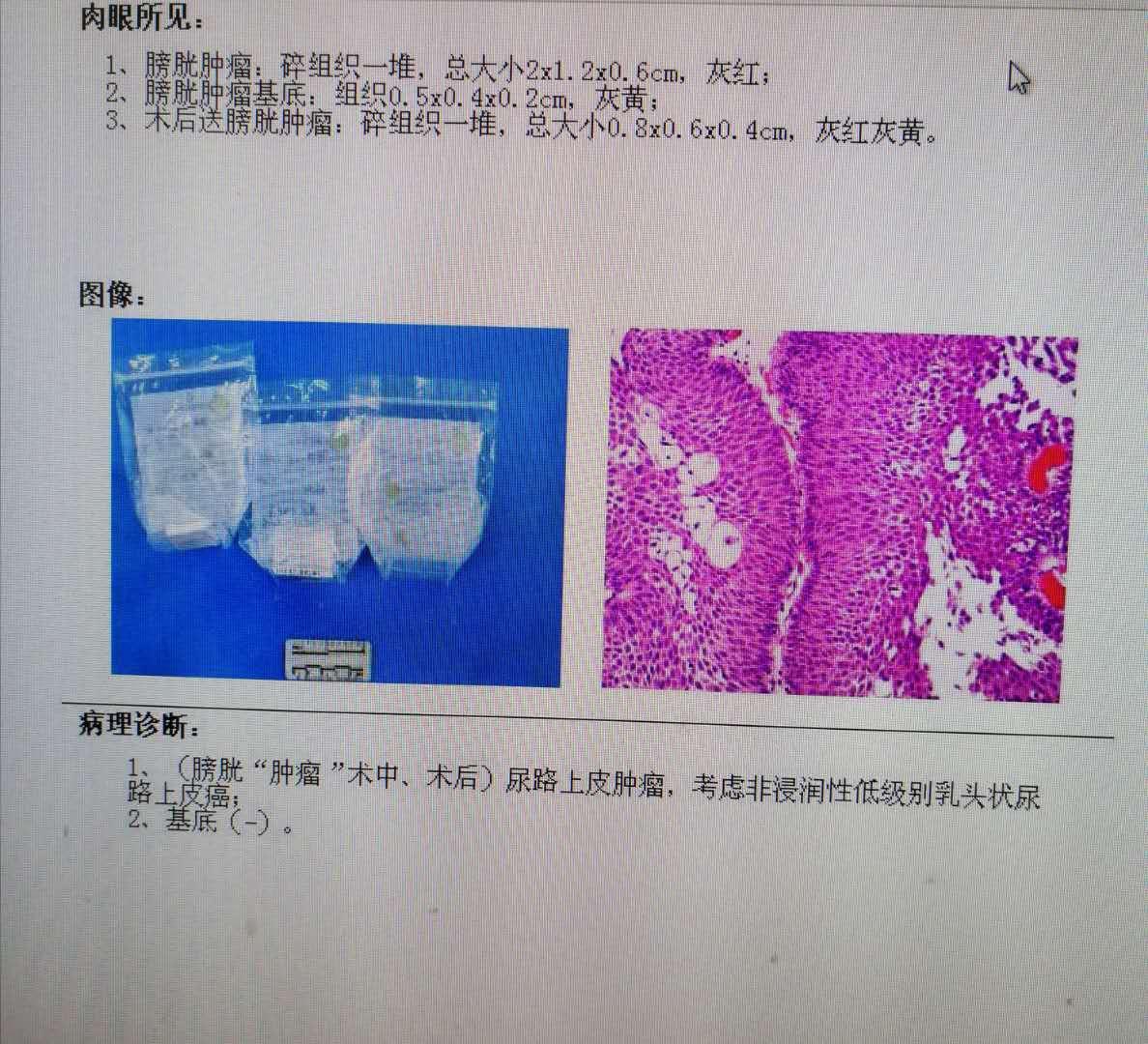 膀胱癌报告图片