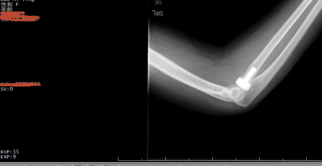 右桡骨粉碎性骨折图片图片
