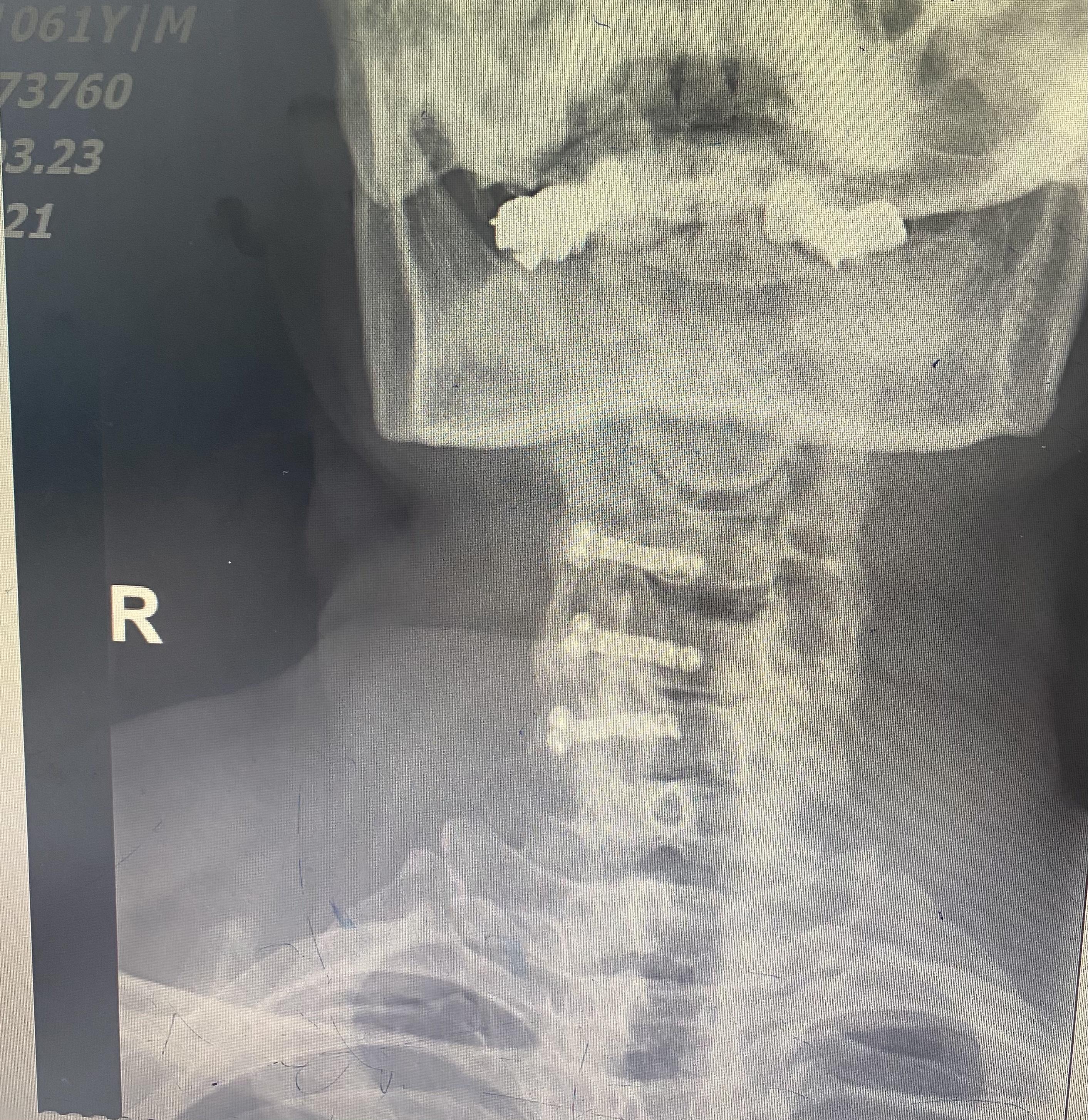 脊髓型颈椎病——颈椎前路减压钛网植骨钢板内固定术 - 好大夫在线