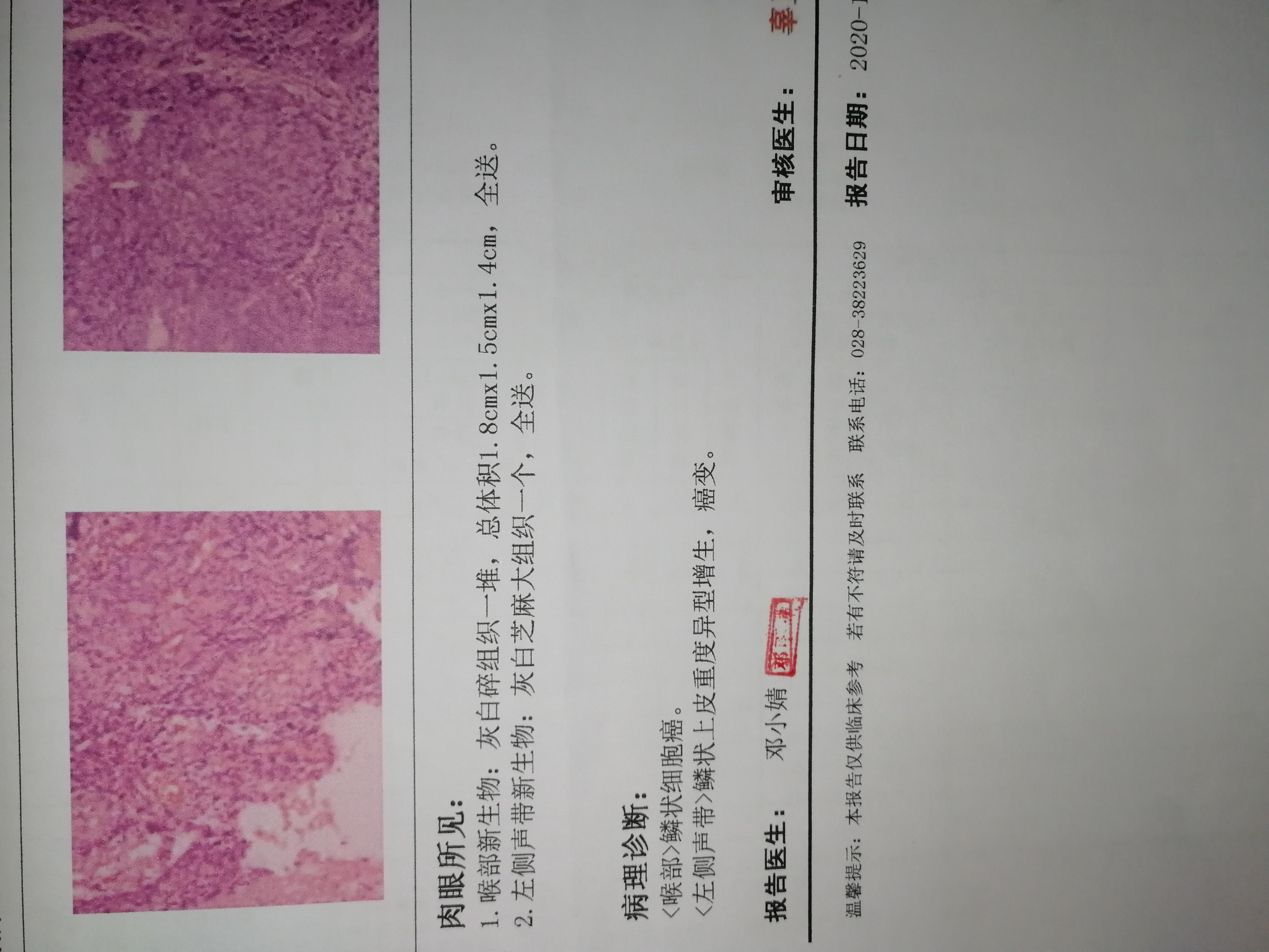 声门型喉癌1例-MedSci.cn