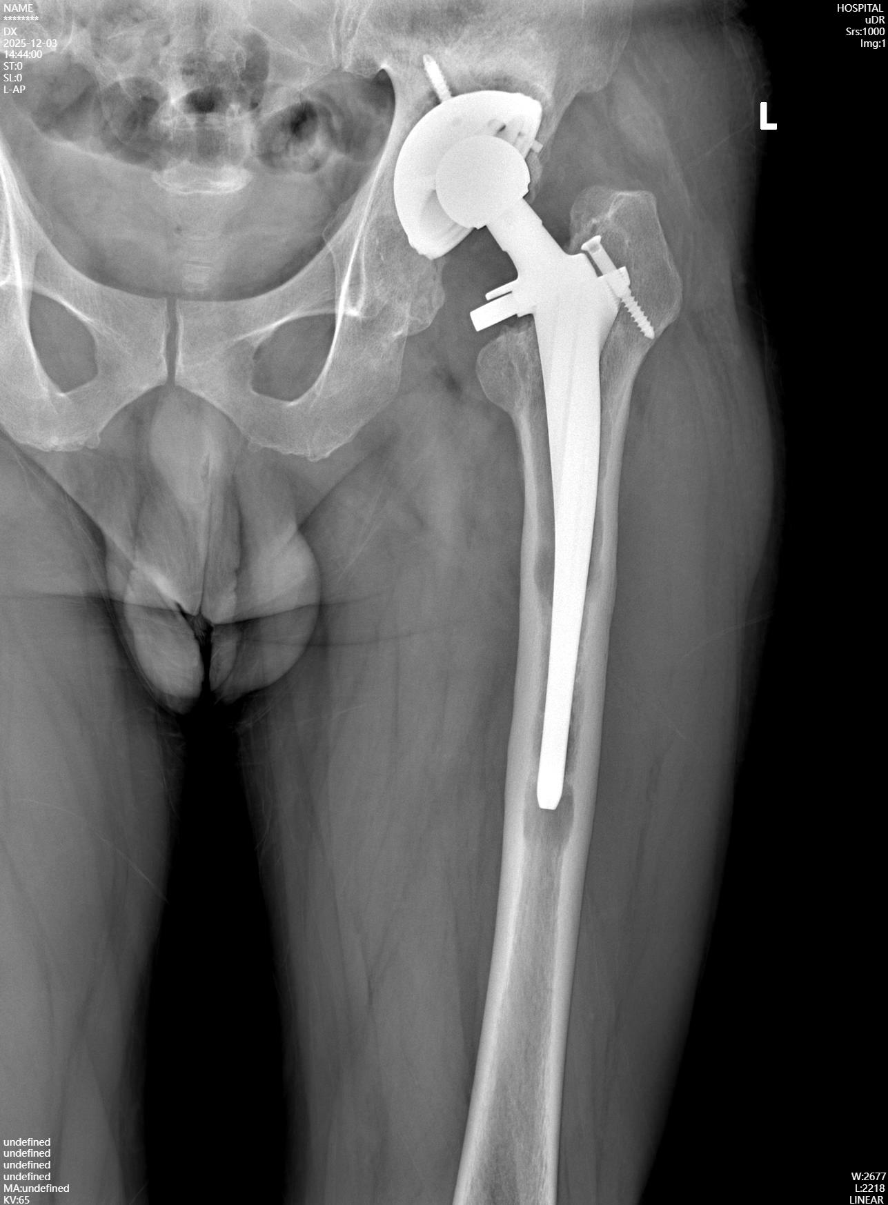 術前正位術前側位術前CT