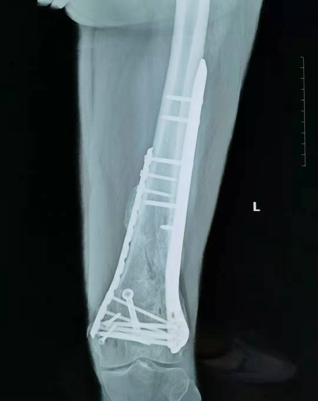 车祸导致的左胫骨平台开放粉碎性骨折并后交叉韧带撕裂的治疗及术后康复疑问。_百度知道