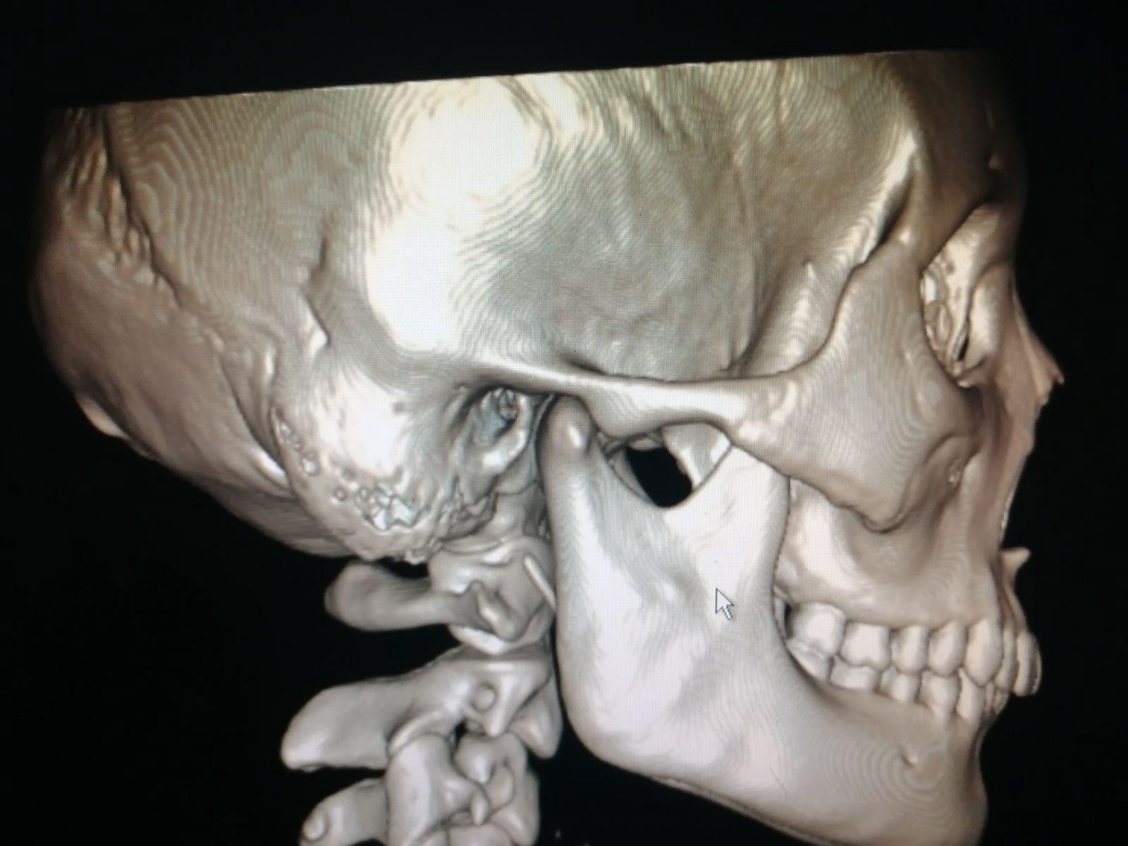 鼻骨骨折 手术图片