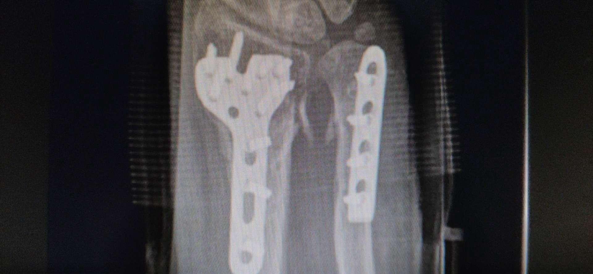 尺桡骨双骨折锁定钢板内固定手术一例