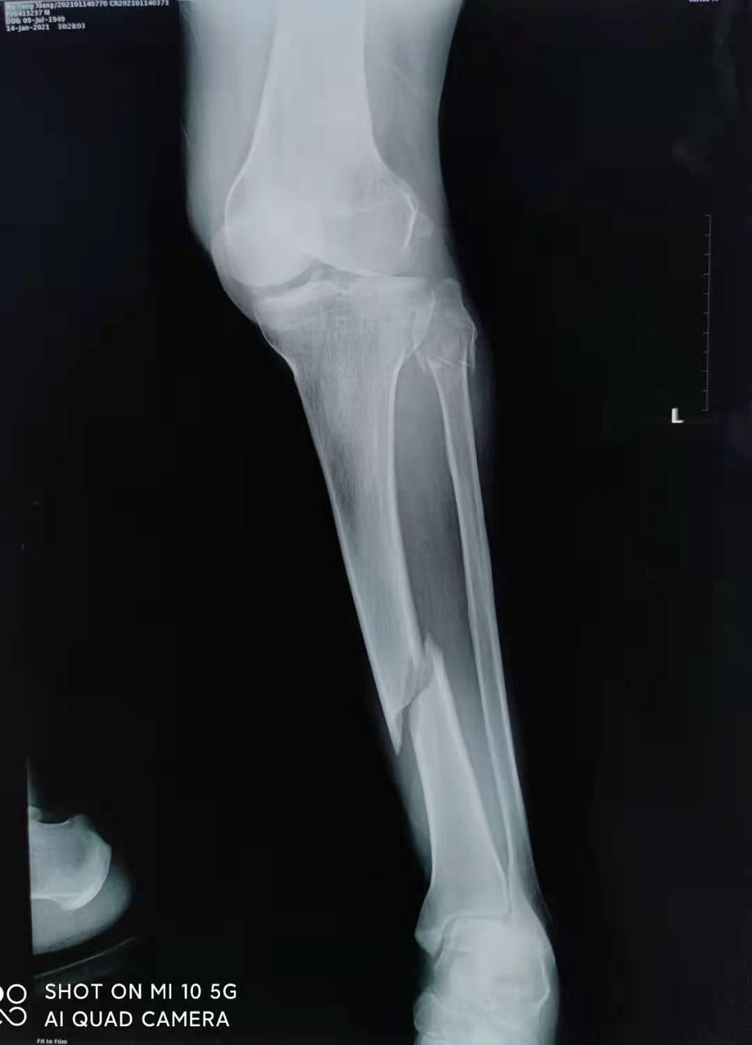 骨一科一例股骨干骨折闭合复位髓内钉内固定术分享_手术