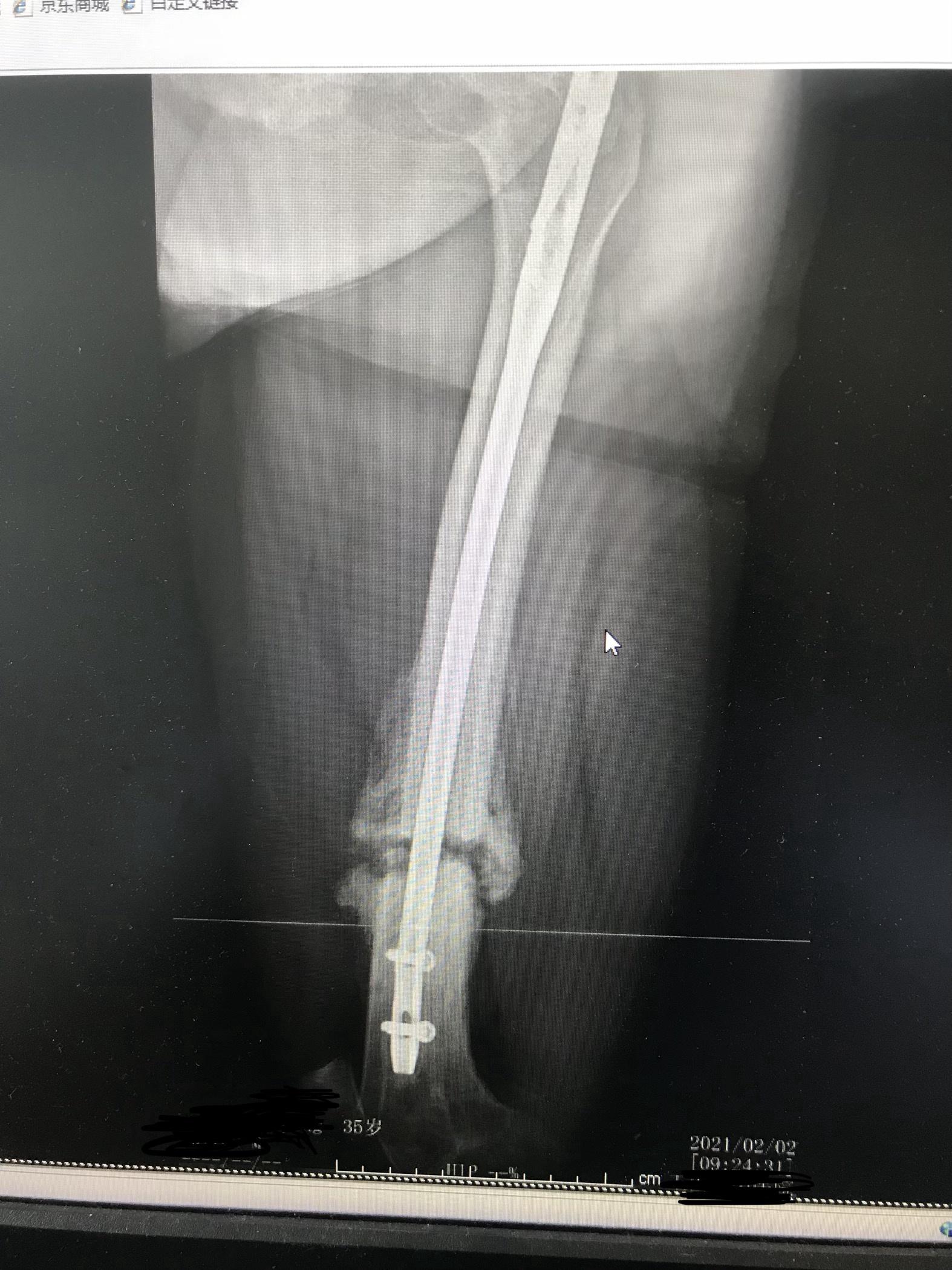 髌骨骨折后钢丝断裂怎么办？-髌骨骨折手术后2个月腿打弯时发现膝盖皮肤被里面异物纵向...