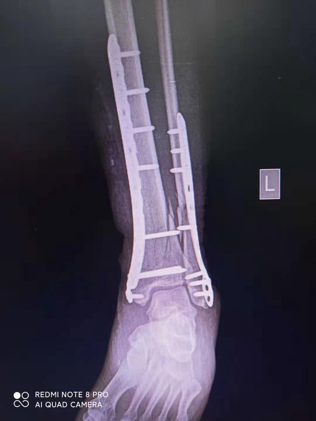桡骨远端骨折钢板固定的手术技巧 - 好医术早读文章 - 好医术-赋能医生守护生命