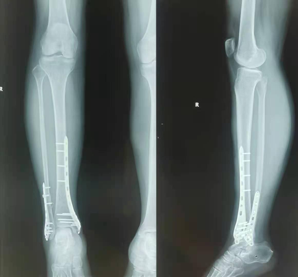 踝关节骨折病例 - 骨科专业讨论版 -丁香园论坛