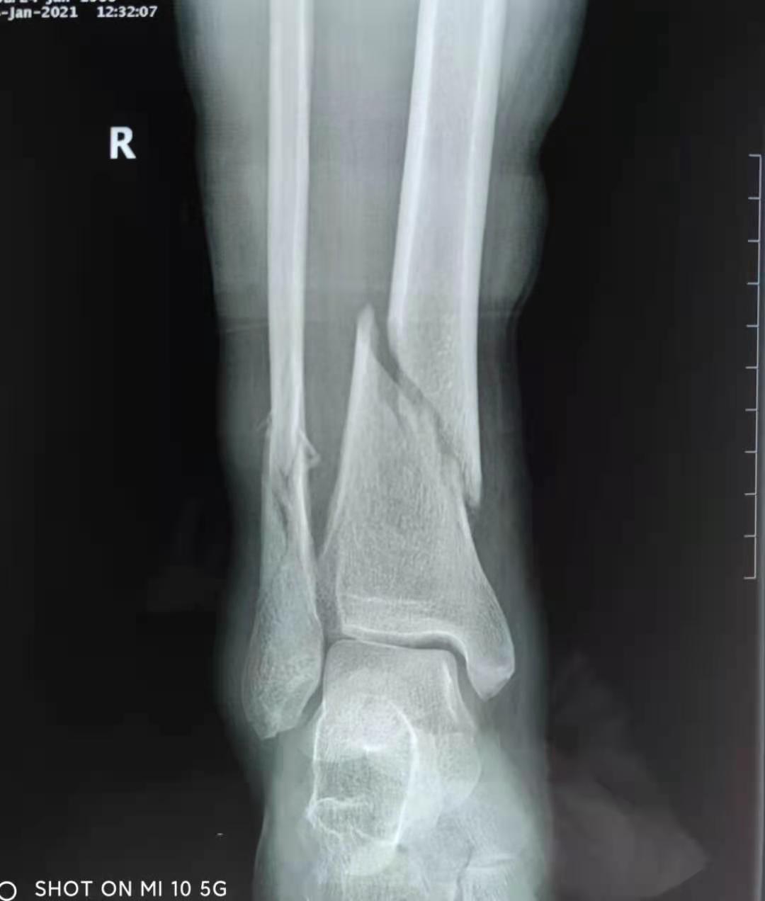 左胫腓骨骨折术后2年骨折不愈合（钢板断裂）-病例讨论-唯医,allinmd