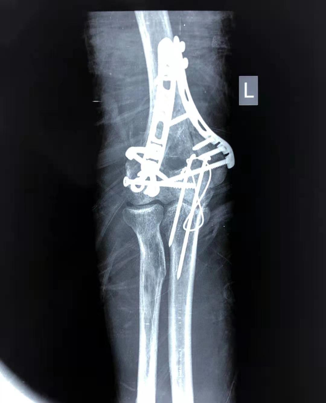 医生必读：骨折中的各种钢板螺钉固定手术技巧 - 知乎