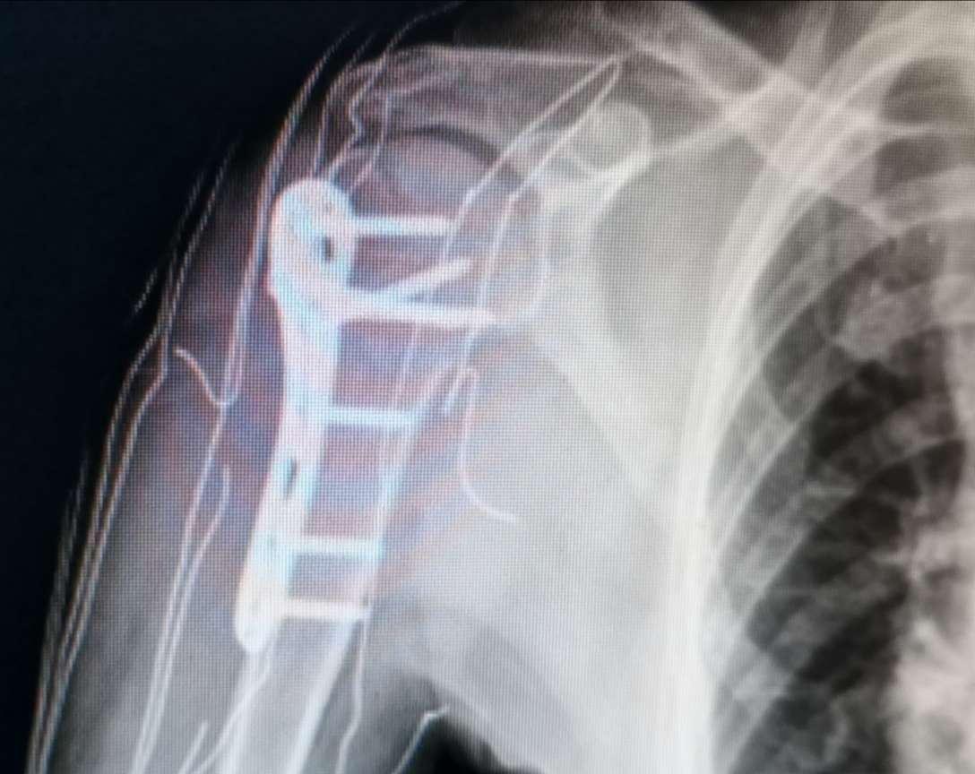 肱骨骨折闭合复位经皮锁定钢板前置内固定术！-德医学院-助力医学教育发展！