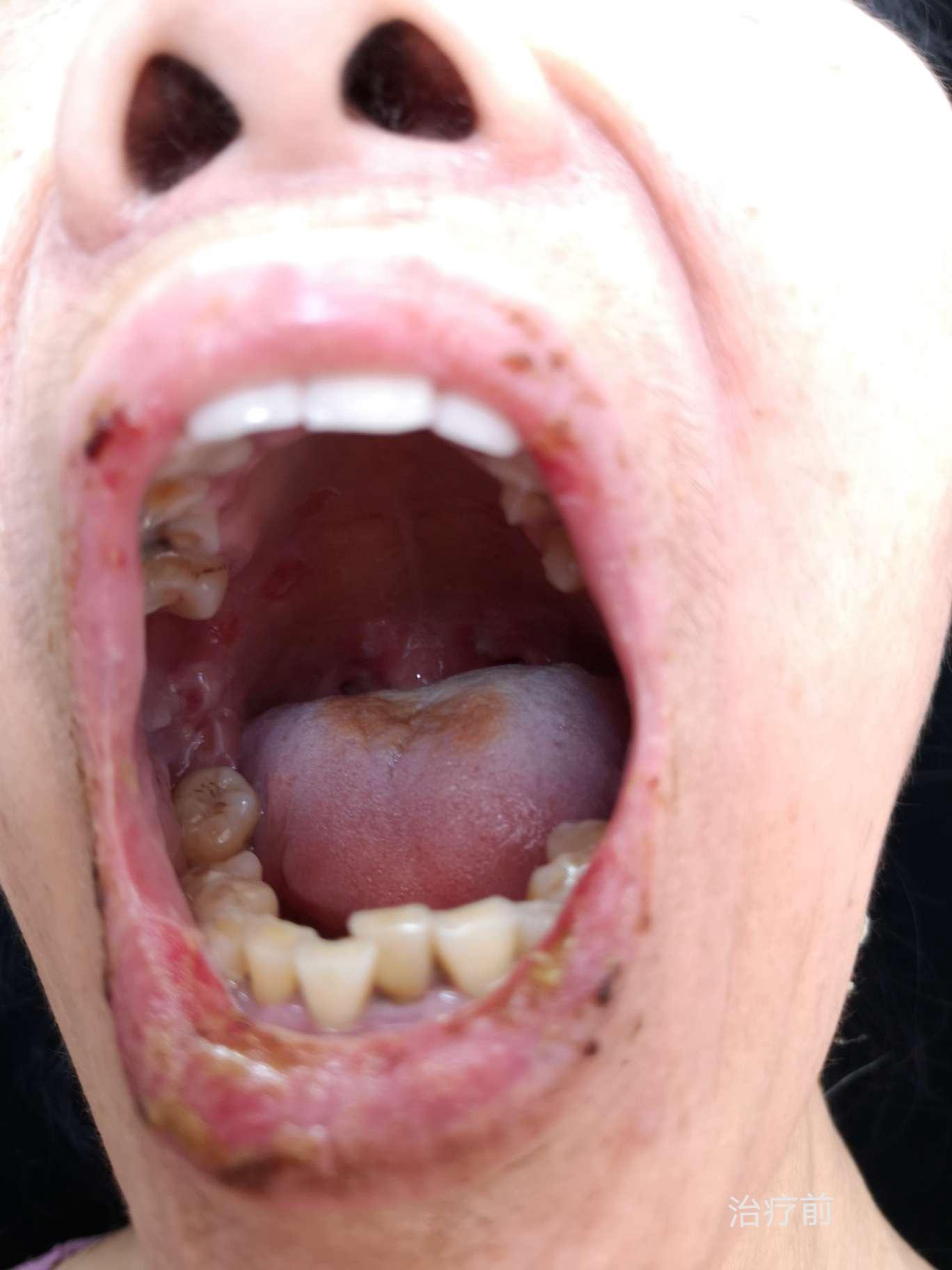 65岁患者口腔黏膜唇部红斑及水疱你能想到它吗