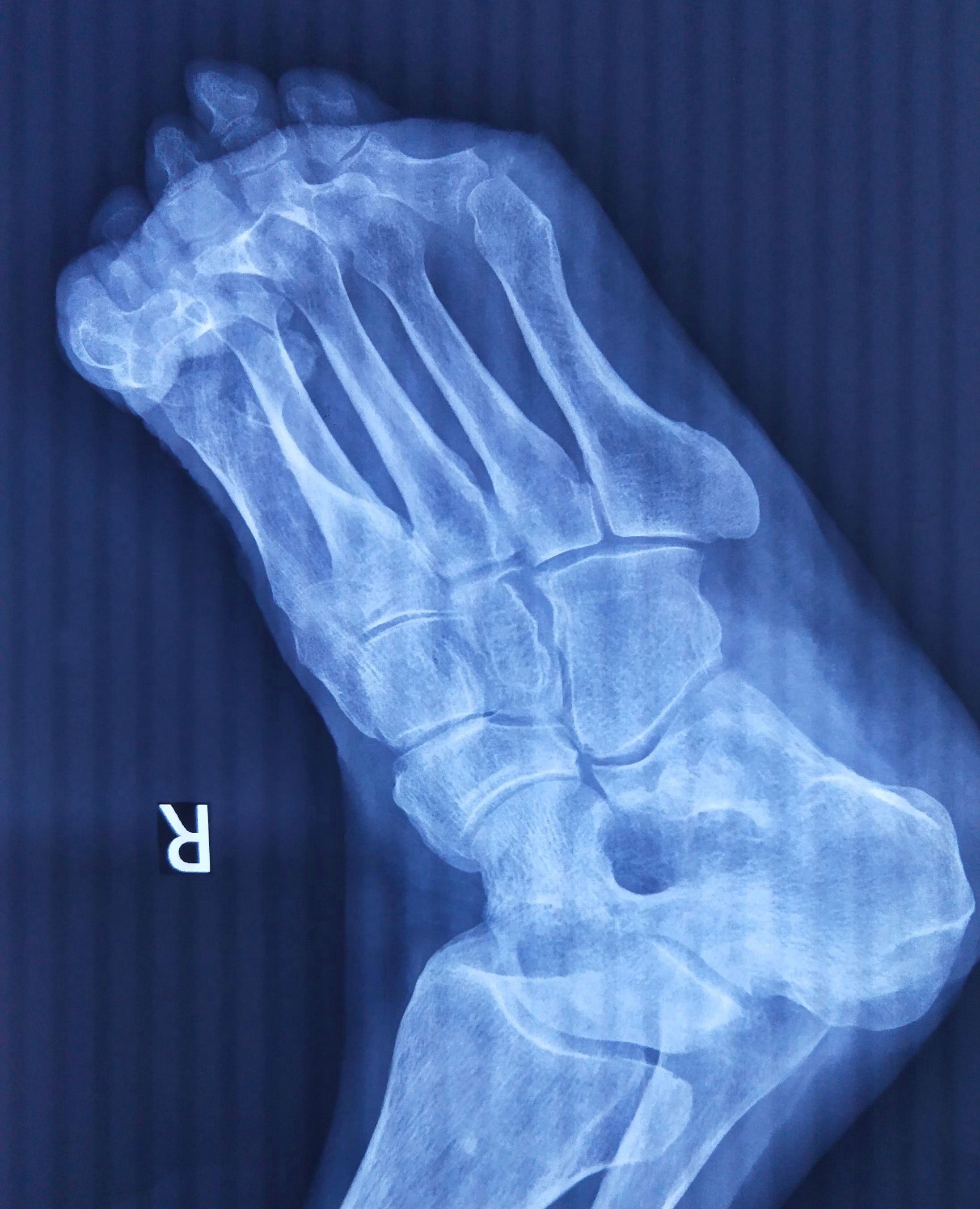 脚拇指粉碎性骨折工伤能评到10级吗？