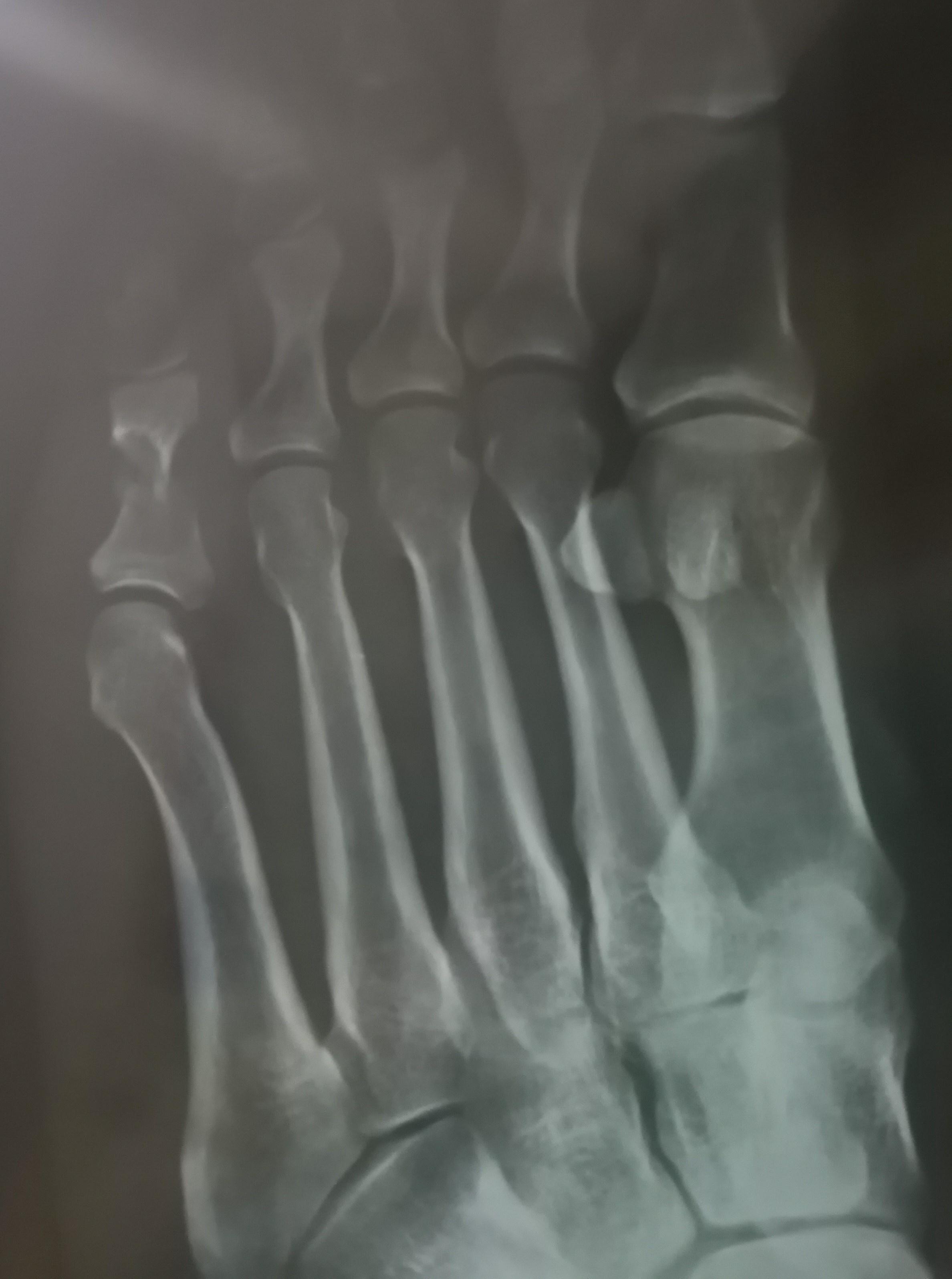 正常的脚趾骨x光图片图片