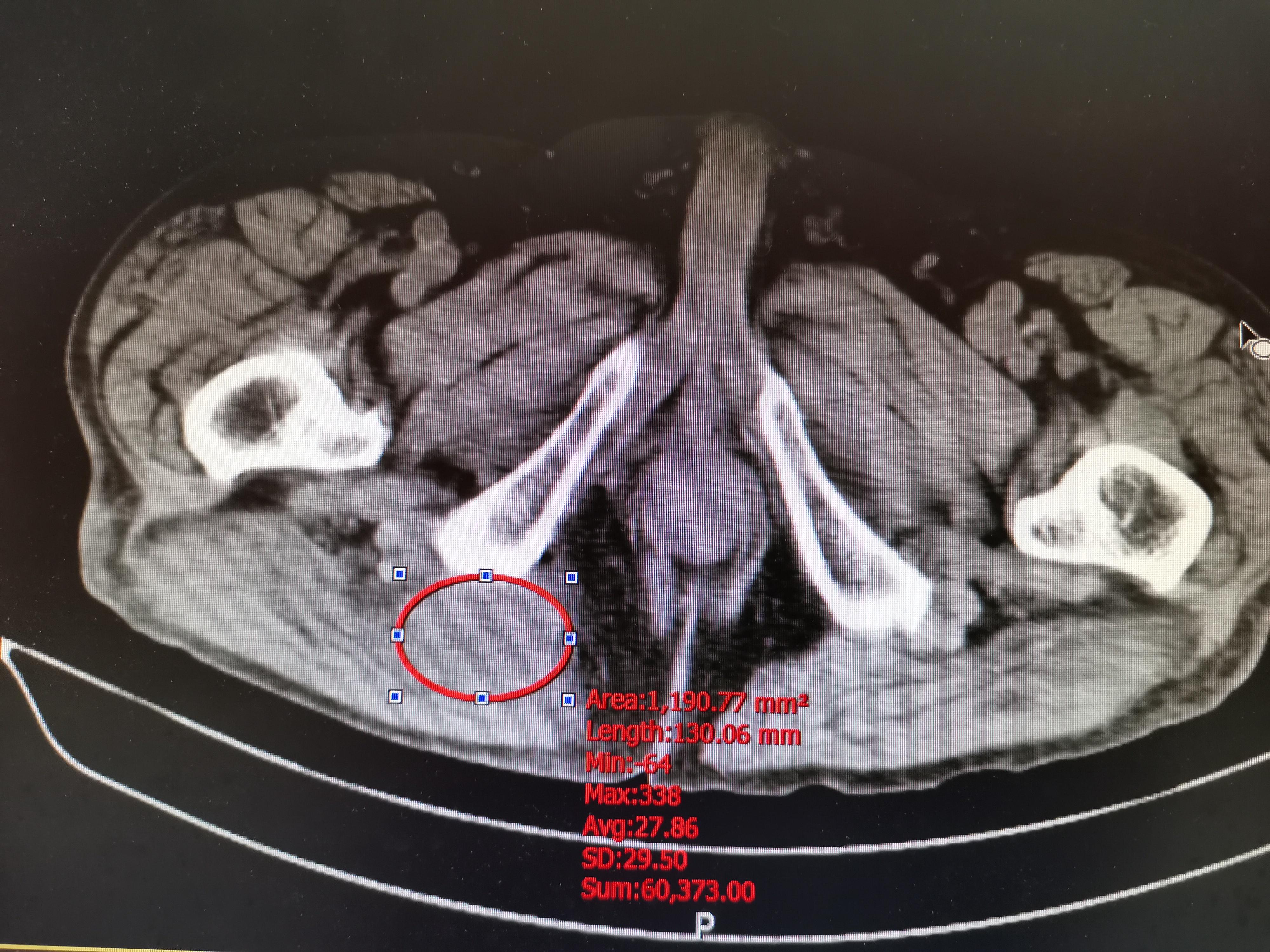 坐骨结节囊肿手术图谱图片