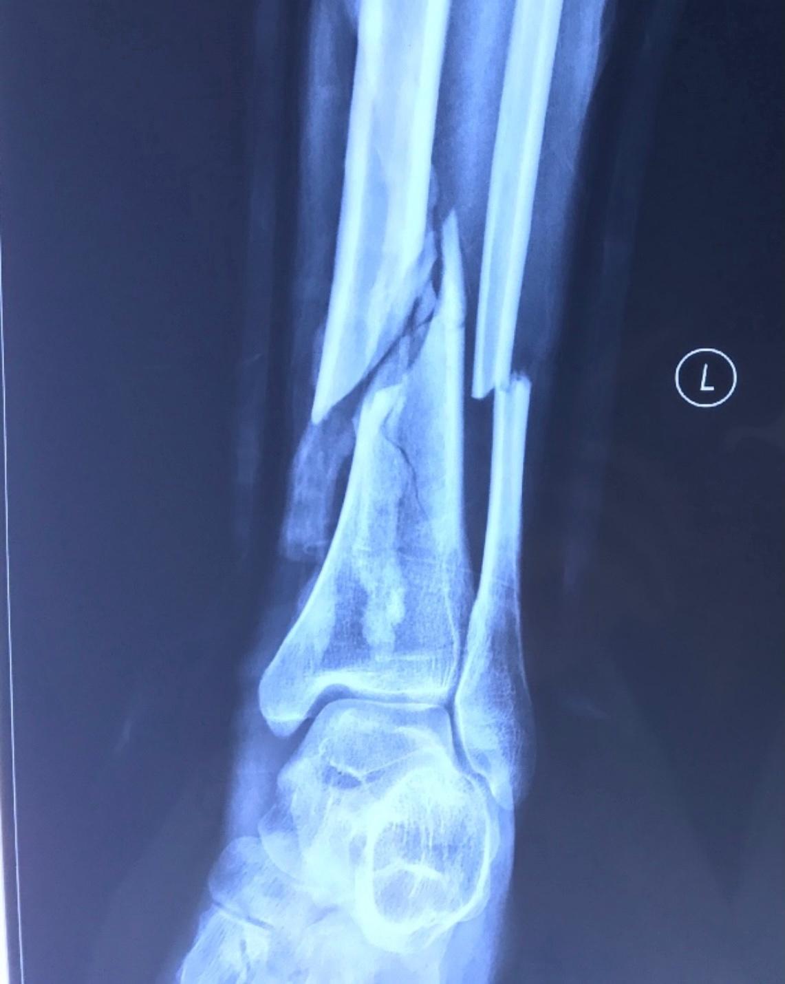 腓骨近端骨折胫腓骨-千图网