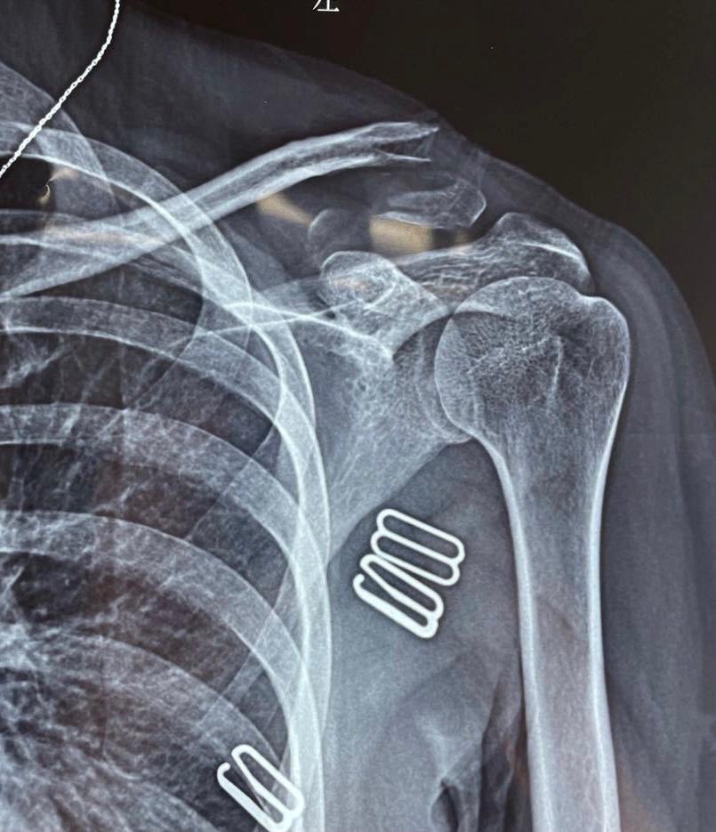 锁骨远端骨折合并喙锁韧带断裂常见的骨折及手术治疗过程总结
