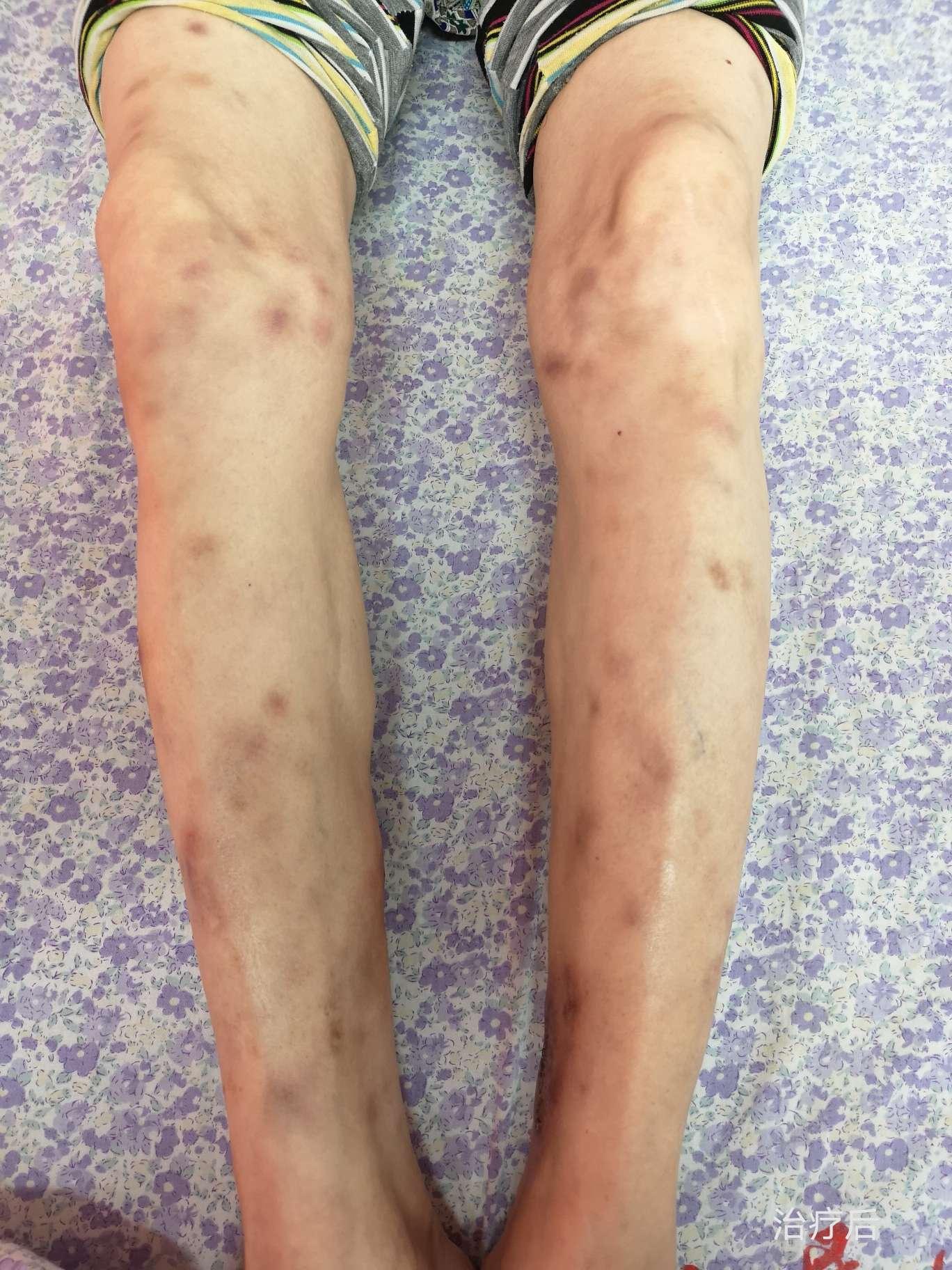 下肢结节性红斑图片