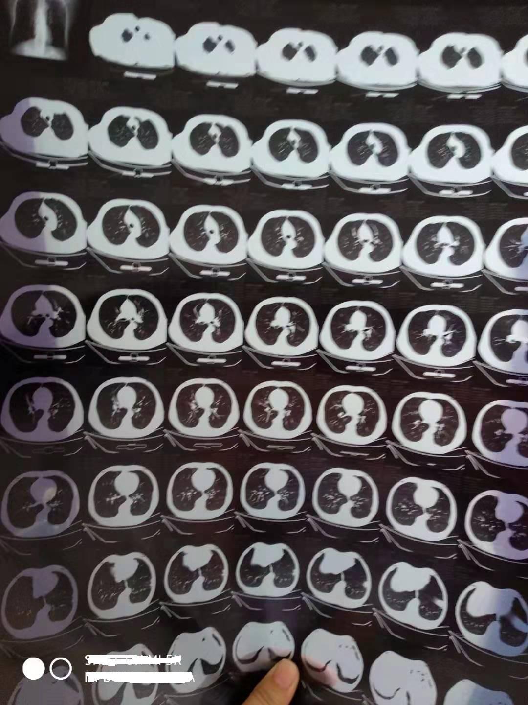 肺源性心脏病引起的慢性咳嗽、咳痰、喘息治疗措施2183浏览#呼吸内科疾病#