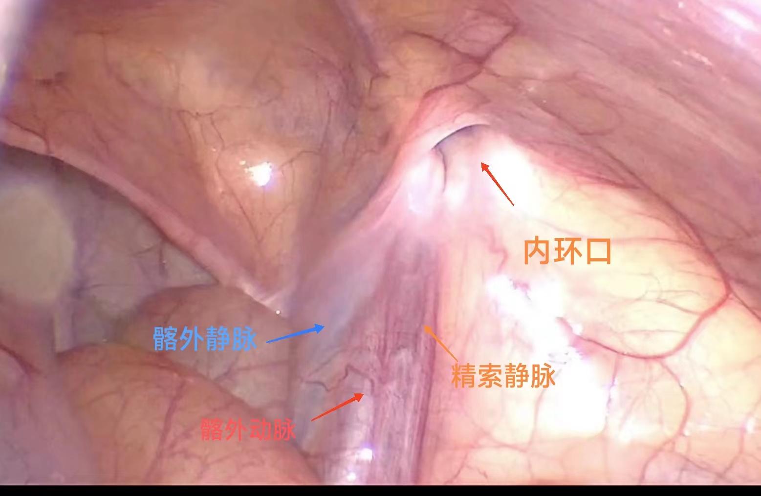 腹腔鏡下鞘膜突高位結扎術：一項高效、安全的微創治療方法