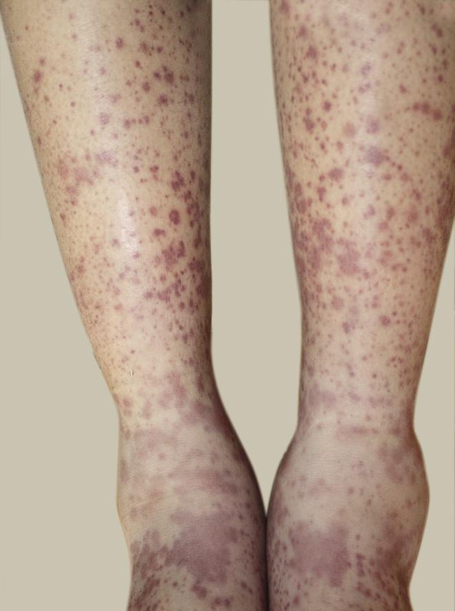 紫癜血管炎的症状图片图片