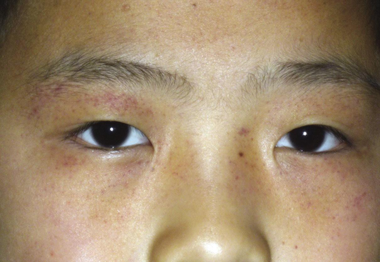 儿童眼部紫癜初期症状图片