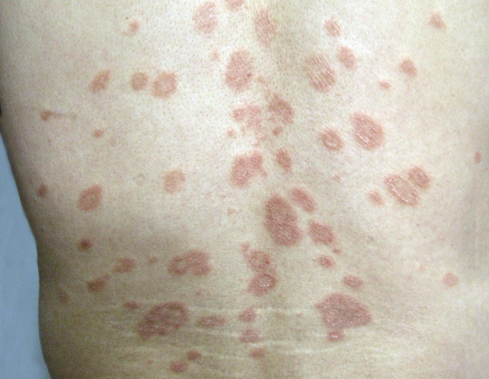 玫瑰糠疹,银屑病,感冒,梅毒,丘疹鳞屑性皮肤病
