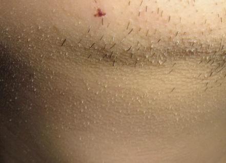 小棘苔藓,丘疹鳞屑性皮肤病