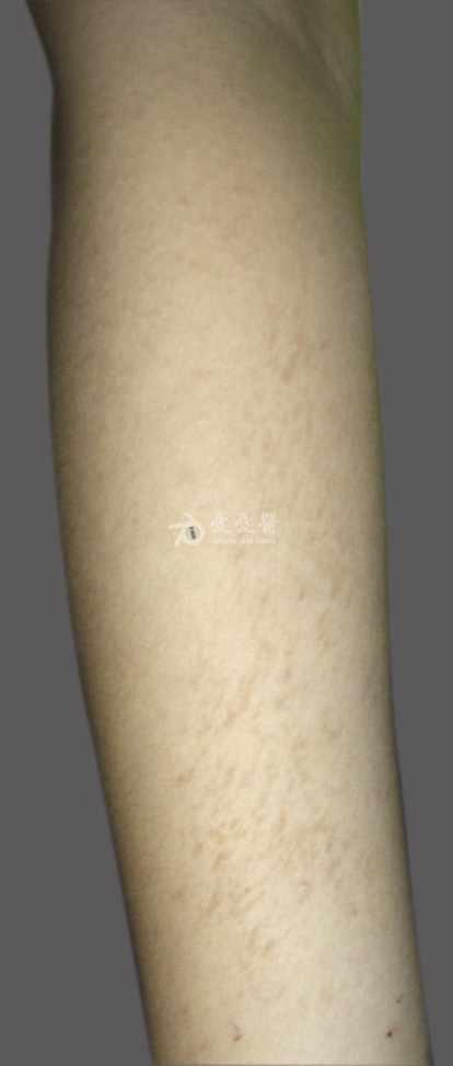 皮肤性病科图谱: 真皮胶原及弹性纤维病 进行性特发性皮肤萎缩